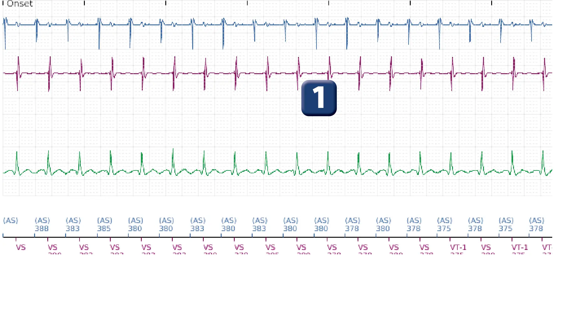 Boston Scientific ICD electrogram, segment 1 of 5 — Dual-chamber discrimination and tachycardia