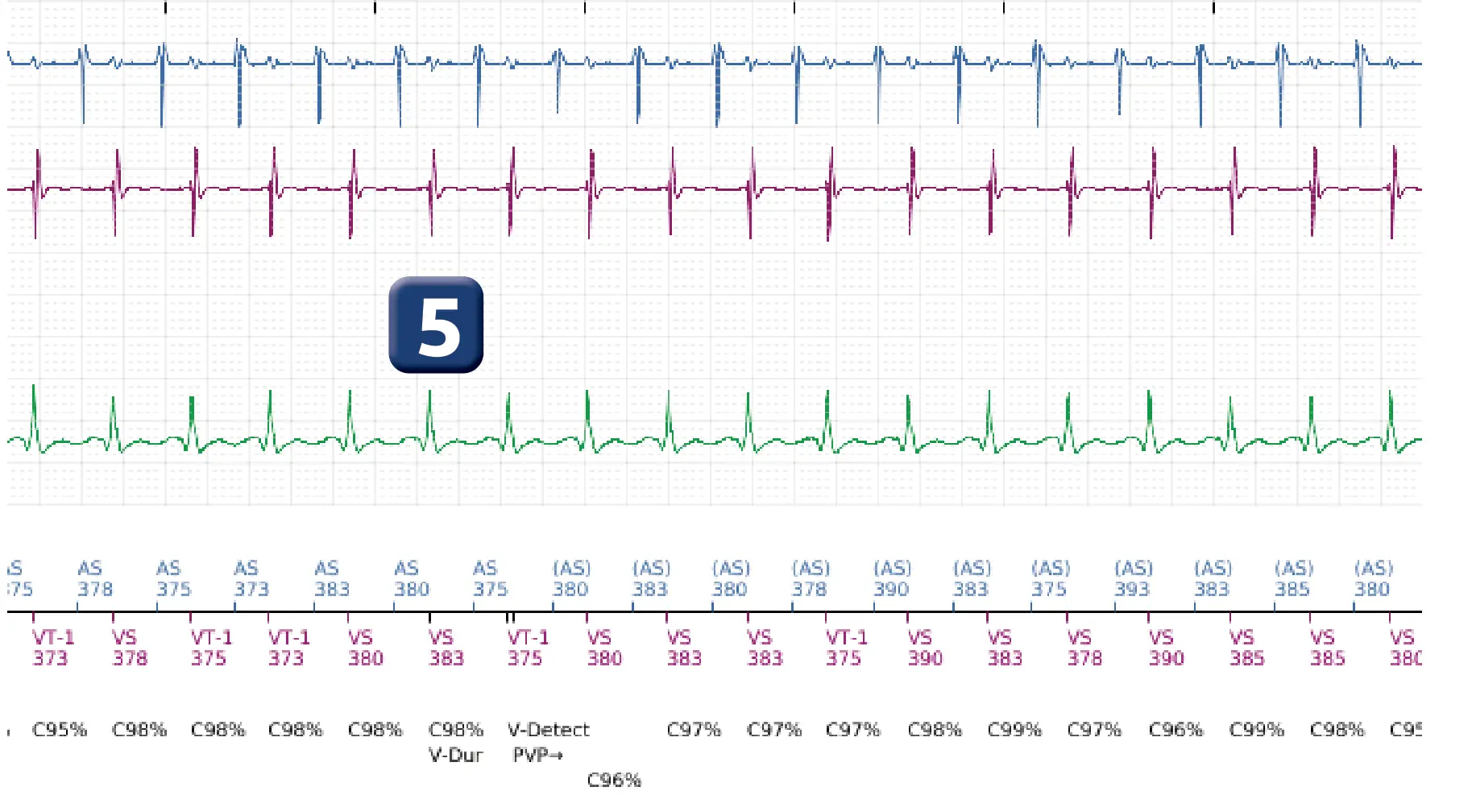 Boston Scientific ICD electrogram, segment 4 of 5 — Dual-chamber discrimination and tachycardia