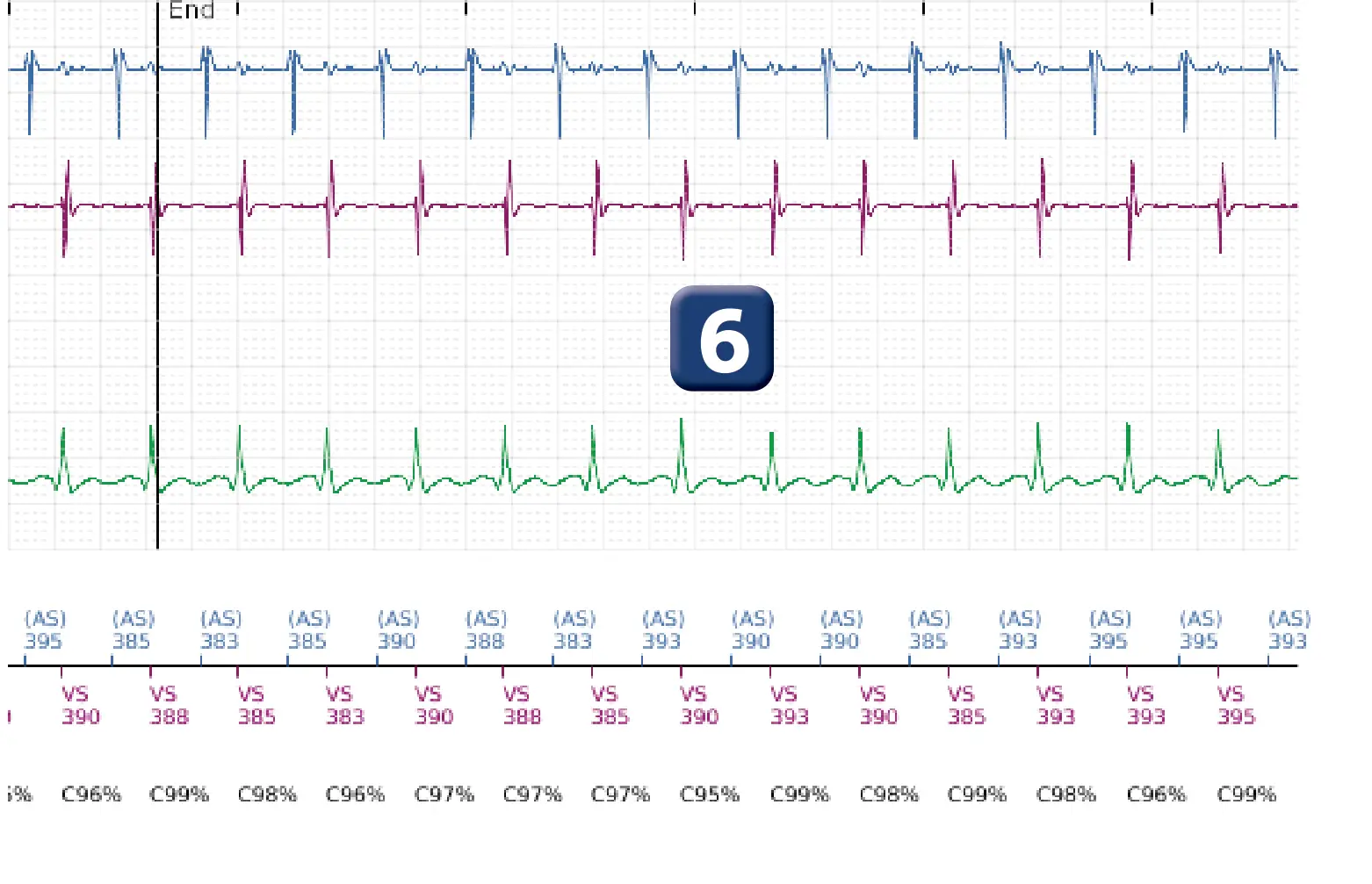 Boston Scientific ICD electrogram, segment 5 of 5 — Dual-chamber discrimination and tachycardia