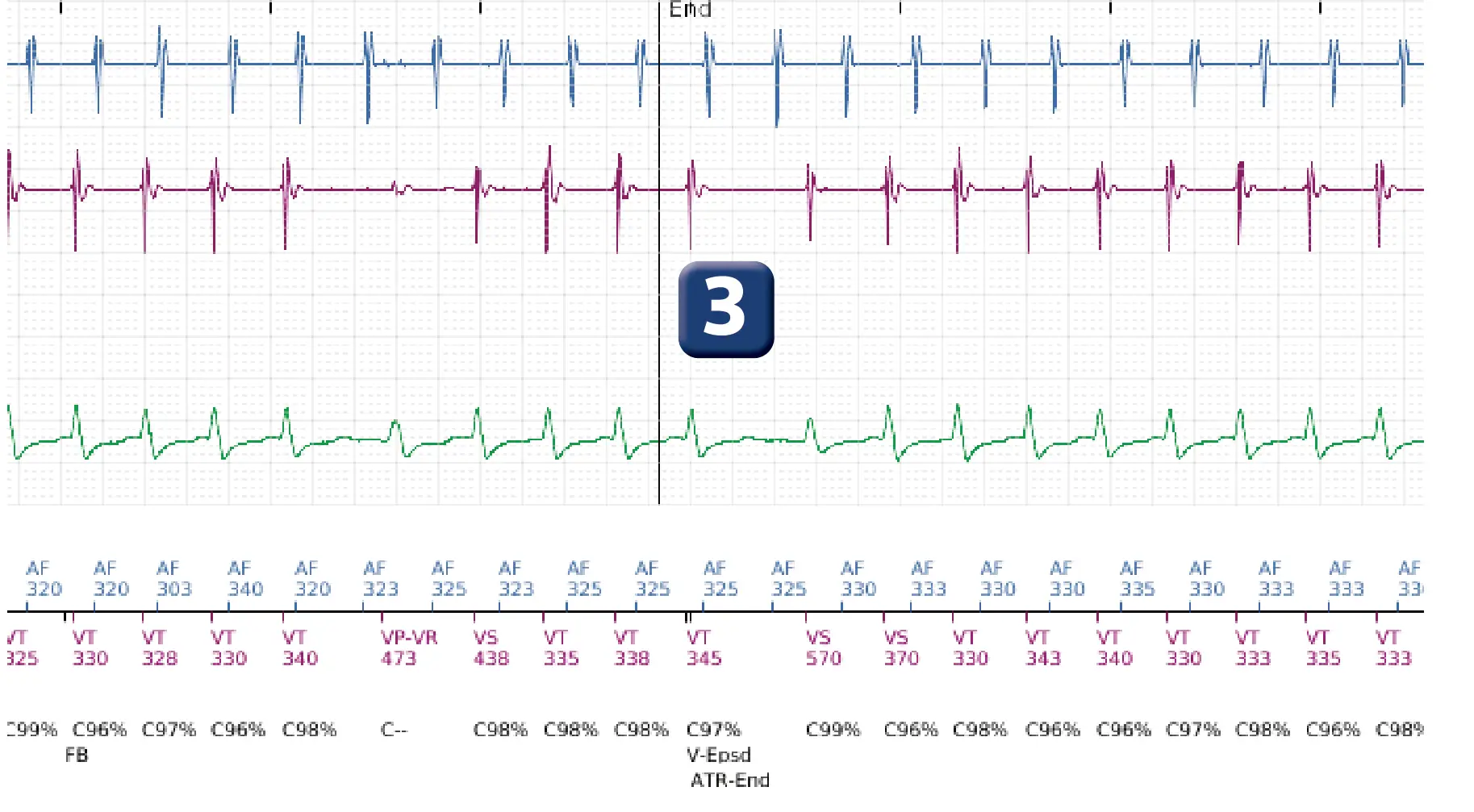 Boston Scientific ICD electrogram, segment 2 of 5 — Dual-chamber discrimination and atrial tachycardia