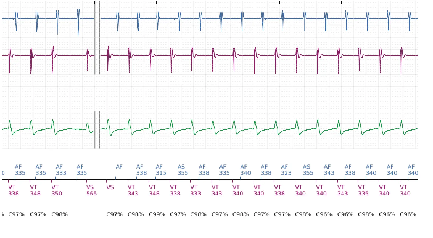 Boston Scientific ICD electrogram, segment 3 of 5 — Dual-chamber discrimination and atrial tachycardia