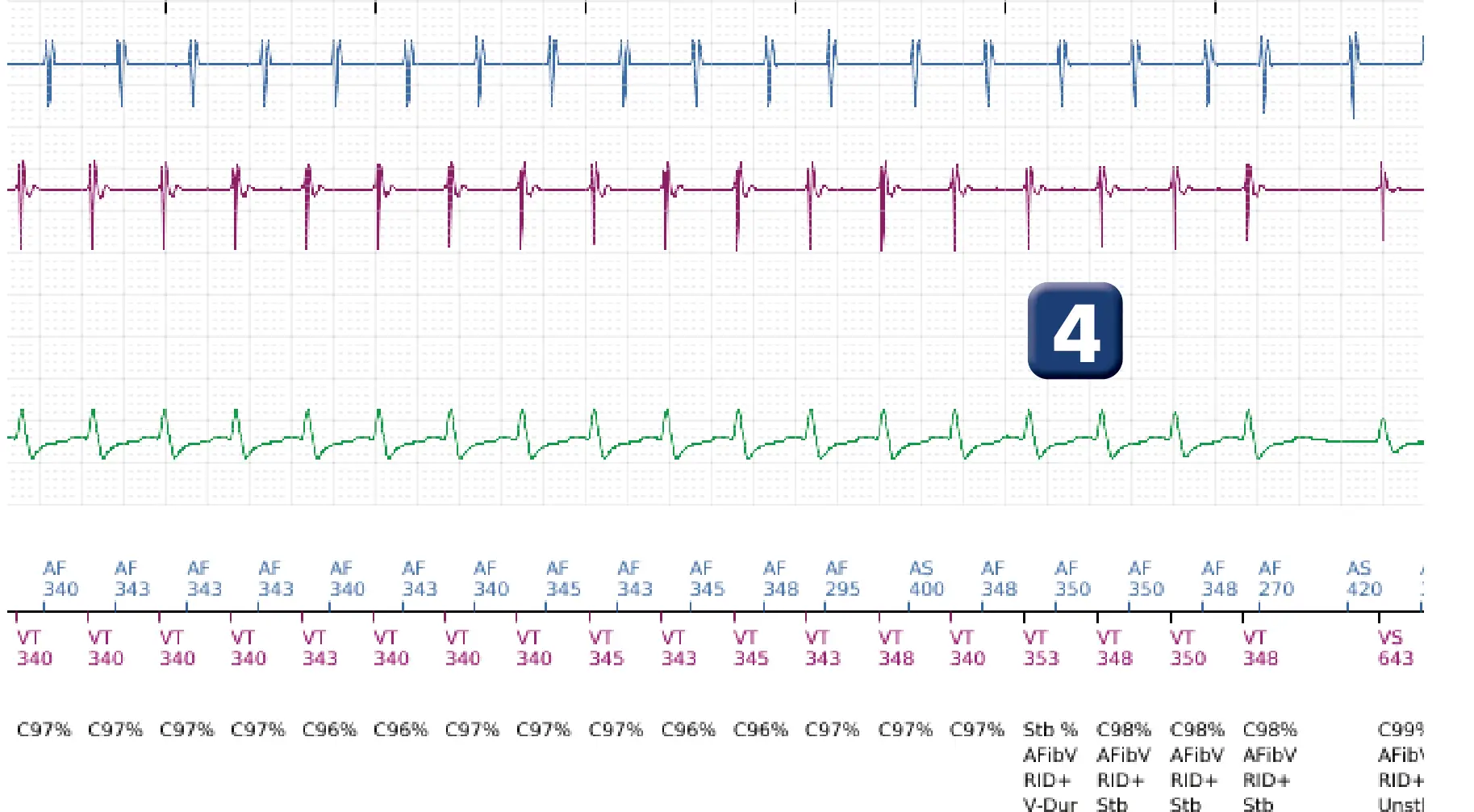 Boston Scientific ICD electrogram, segment 4 of 5 — Dual-chamber discrimination and atrial tachycardia