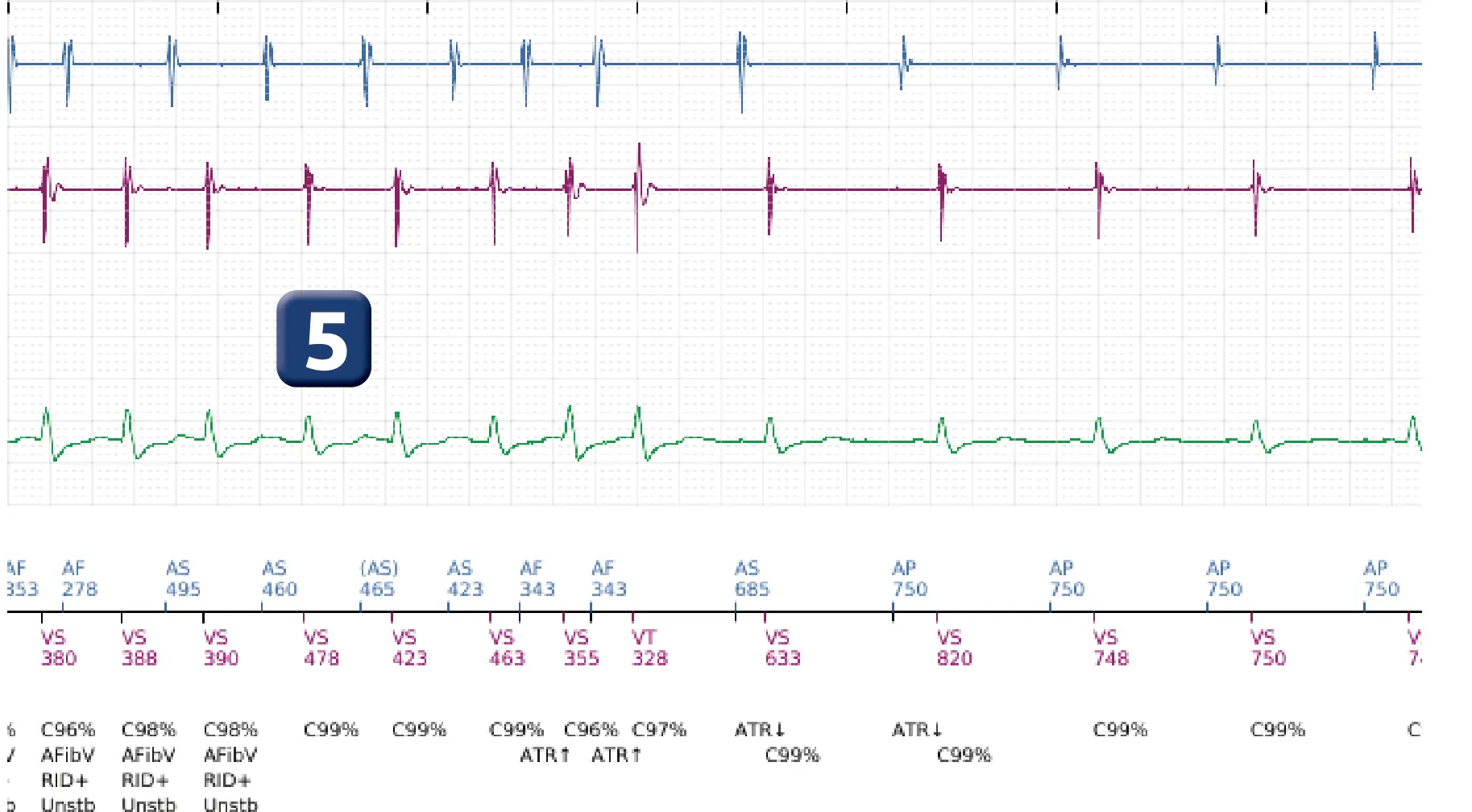 Boston Scientific ICD electrogram, segment 5 of 5 — Dual-chamber discrimination and atrial tachycardia