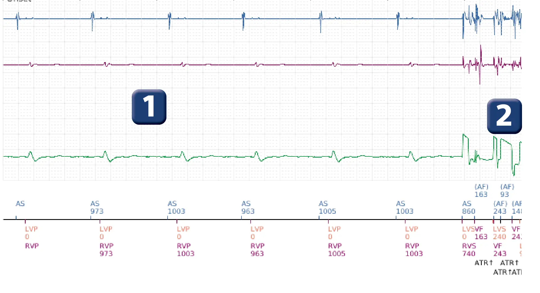 Boston Scientific ICD electrogram, segment 1 of 3 — Oversensing of electrocautery