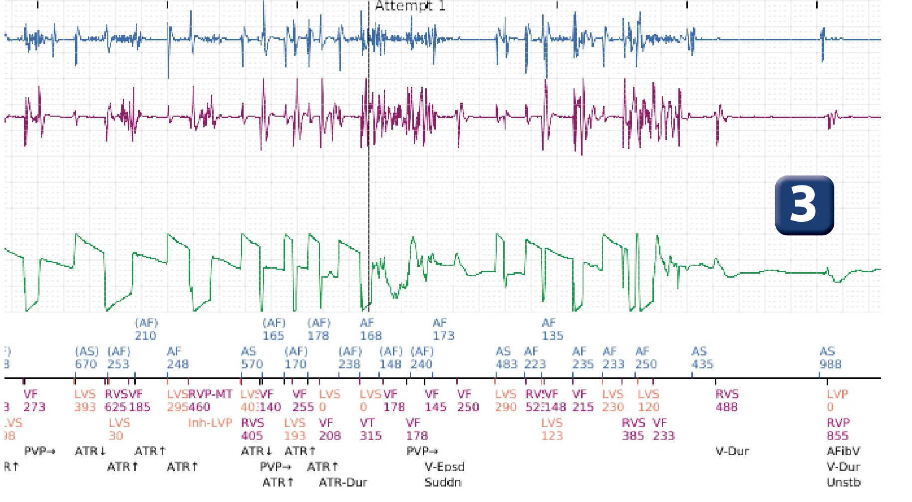 Boston Scientific ICD electrogram, segment 2 of 3 — Oversensing of electrocautery