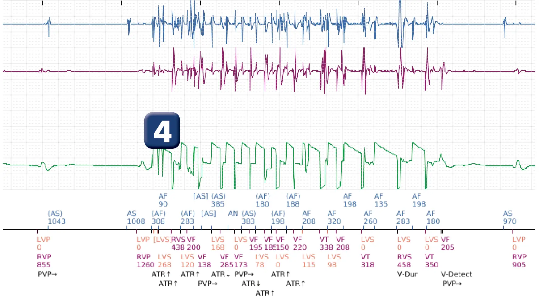 Boston Scientific ICD electrogram, segment 3 of 3 — Oversensing of electrocautery