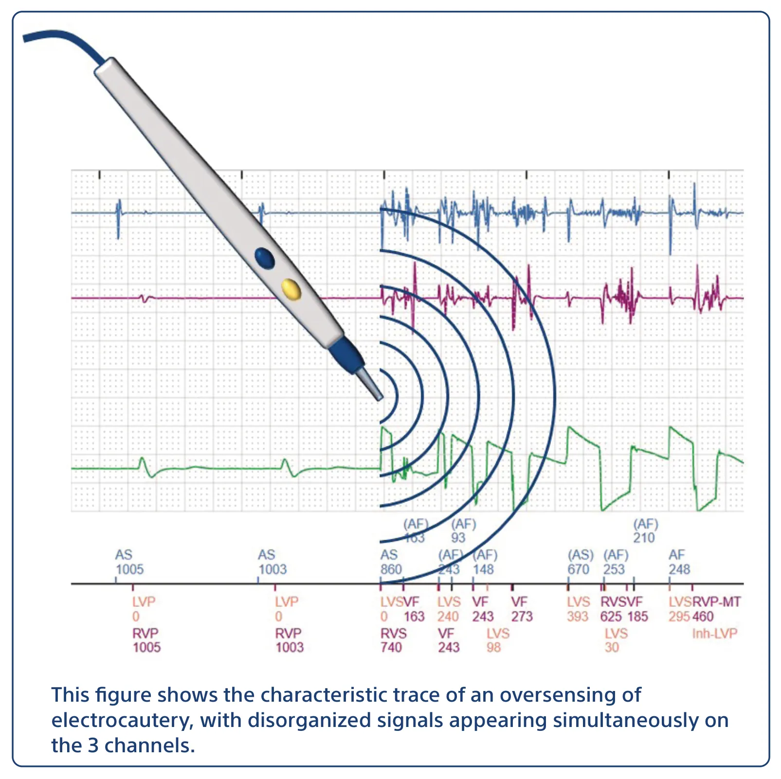 This figure shows the characteristic trace of an oversensing of electrocautery, with disorganized signals appearing simultaneously on the 3 channels.