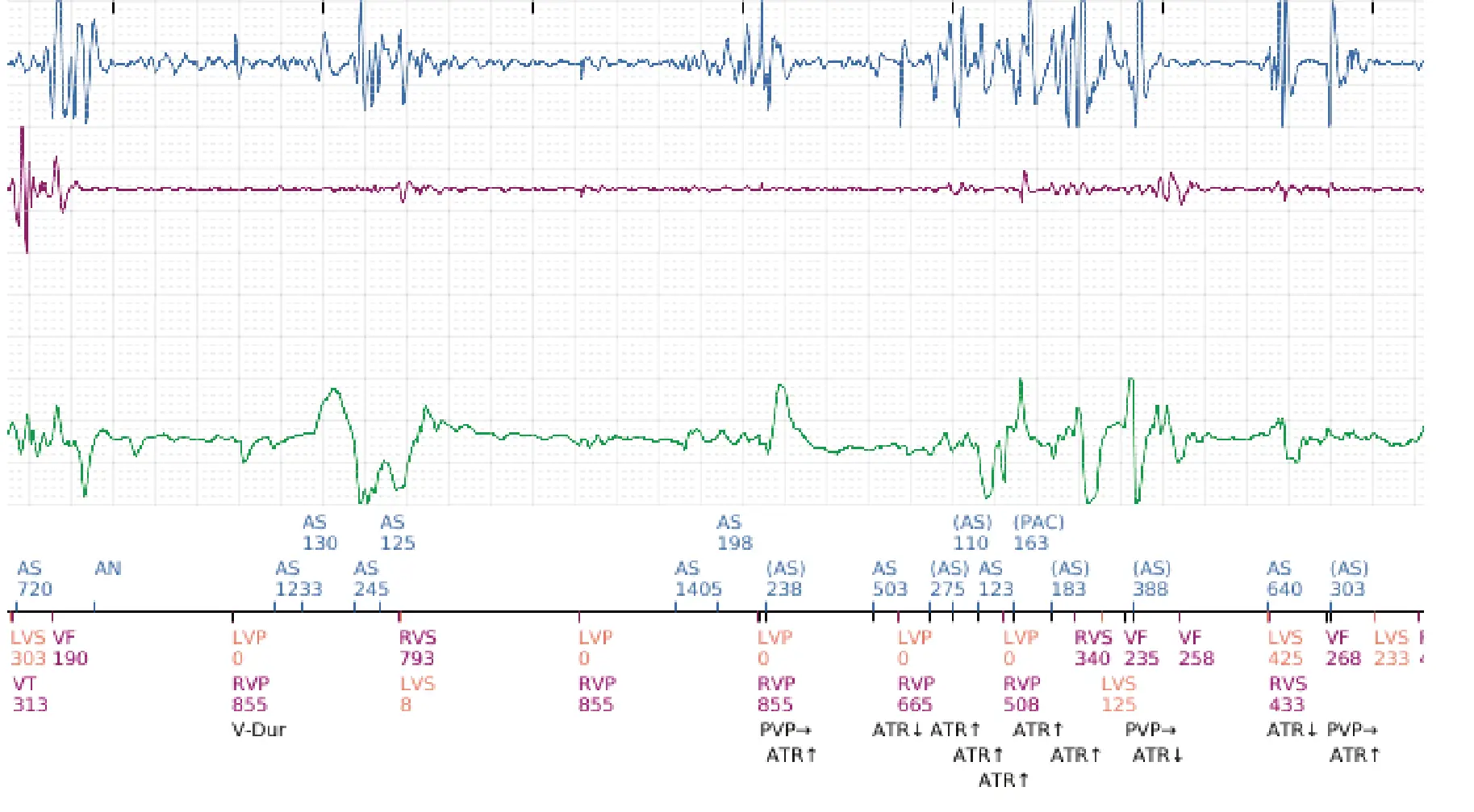 Boston Scientific ICD electrogram, segment 2 of 2 — Surgical intervention and VF at the time of reperfusion