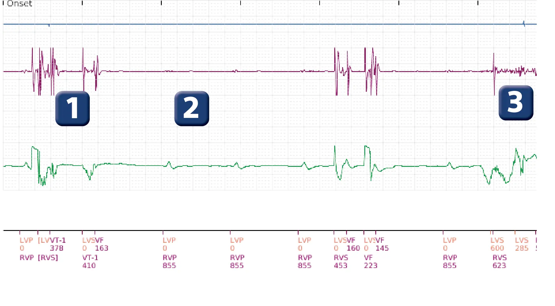 Boston Scientific ICD electrogram, segment 1 of 5 — Surgical intervention and VF at the time of reperfusion