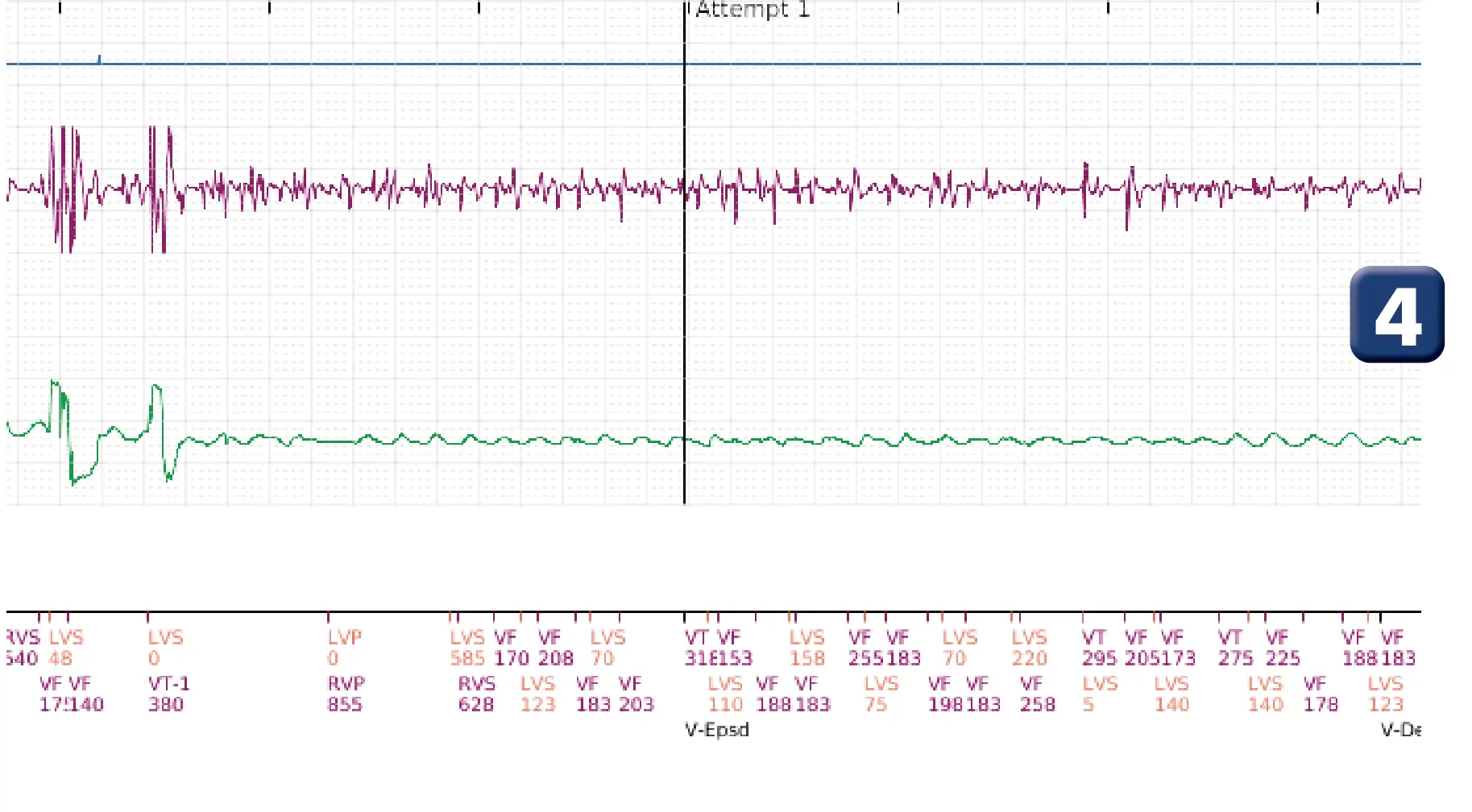 Boston Scientific ICD electrogram, segment 2 of 5 — Surgical intervention and VF at the time of reperfusion