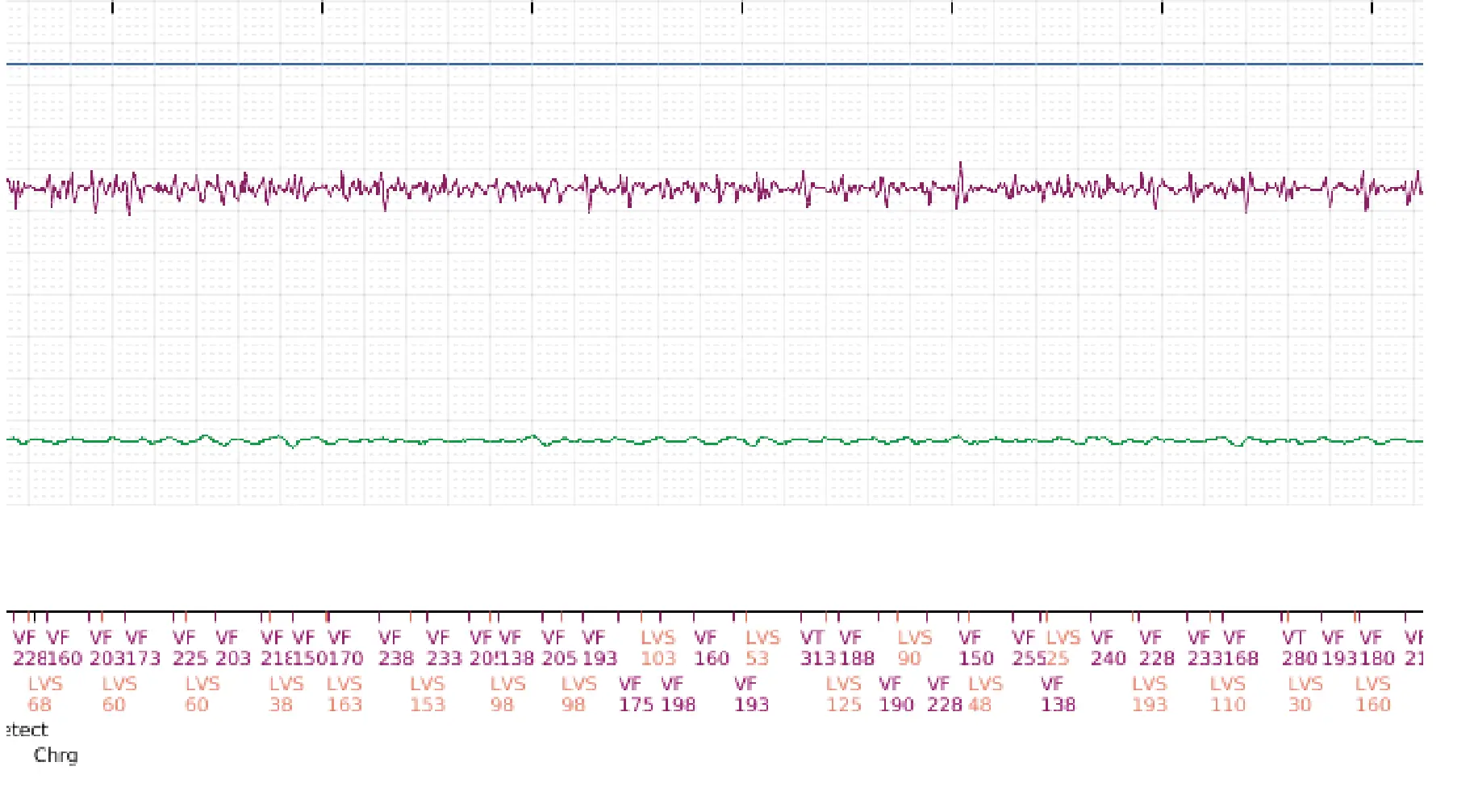 Boston Scientific ICD electrogram, segment 3 of 5 — Surgical intervention and VF at the time of reperfusion