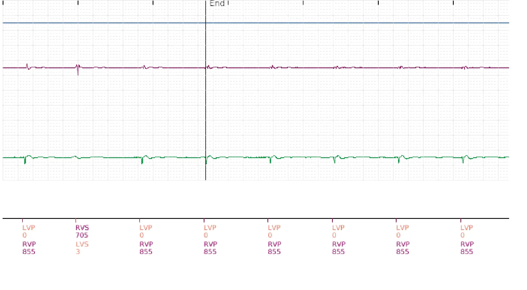Boston Scientific ICD electrogram, segment 5 of 5 — Surgical intervention and VF at the time of reperfusion