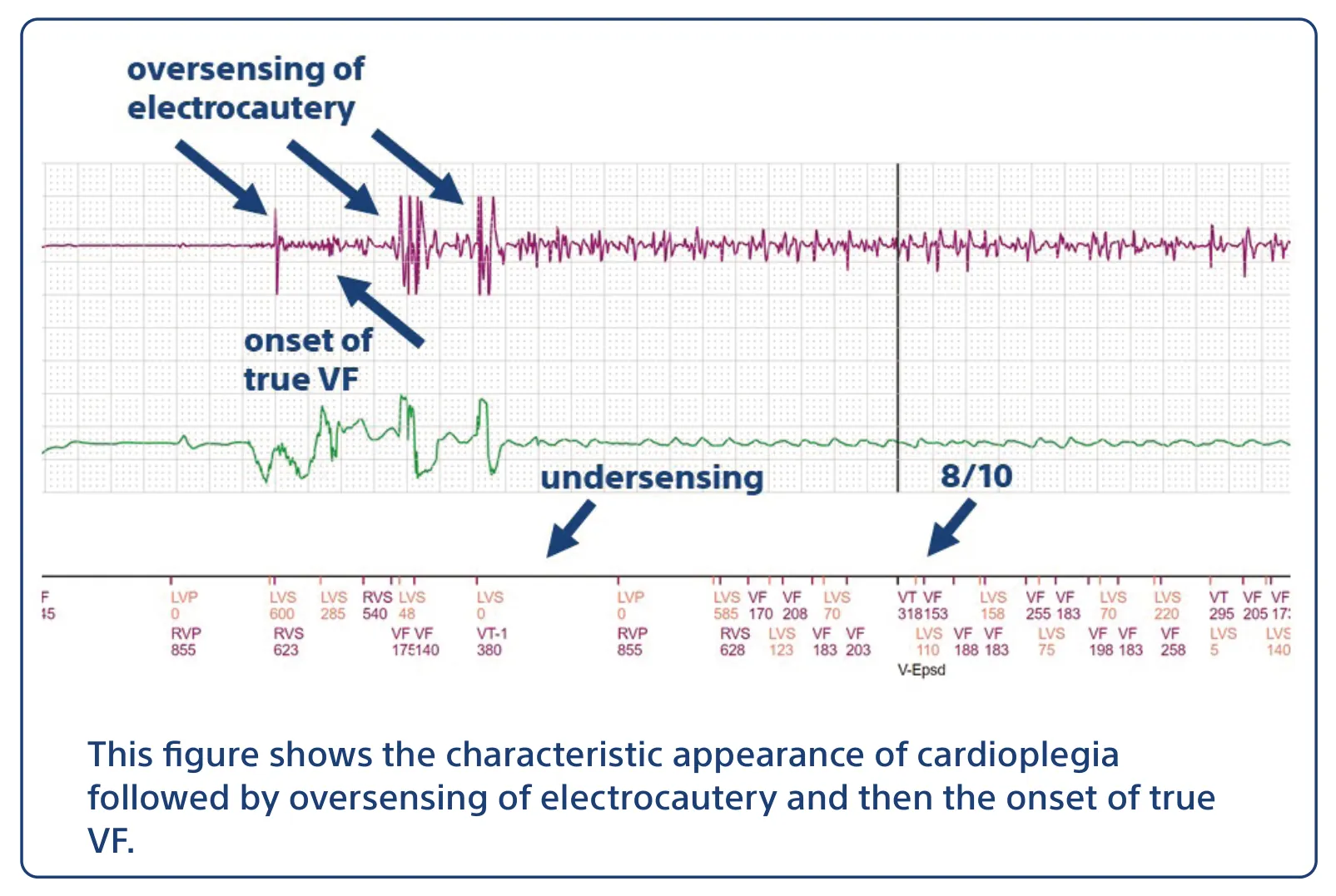 This figure shows the characteristic appearance of cardioplegia followed by oversensing of electrocautery and then the onset of true VF.