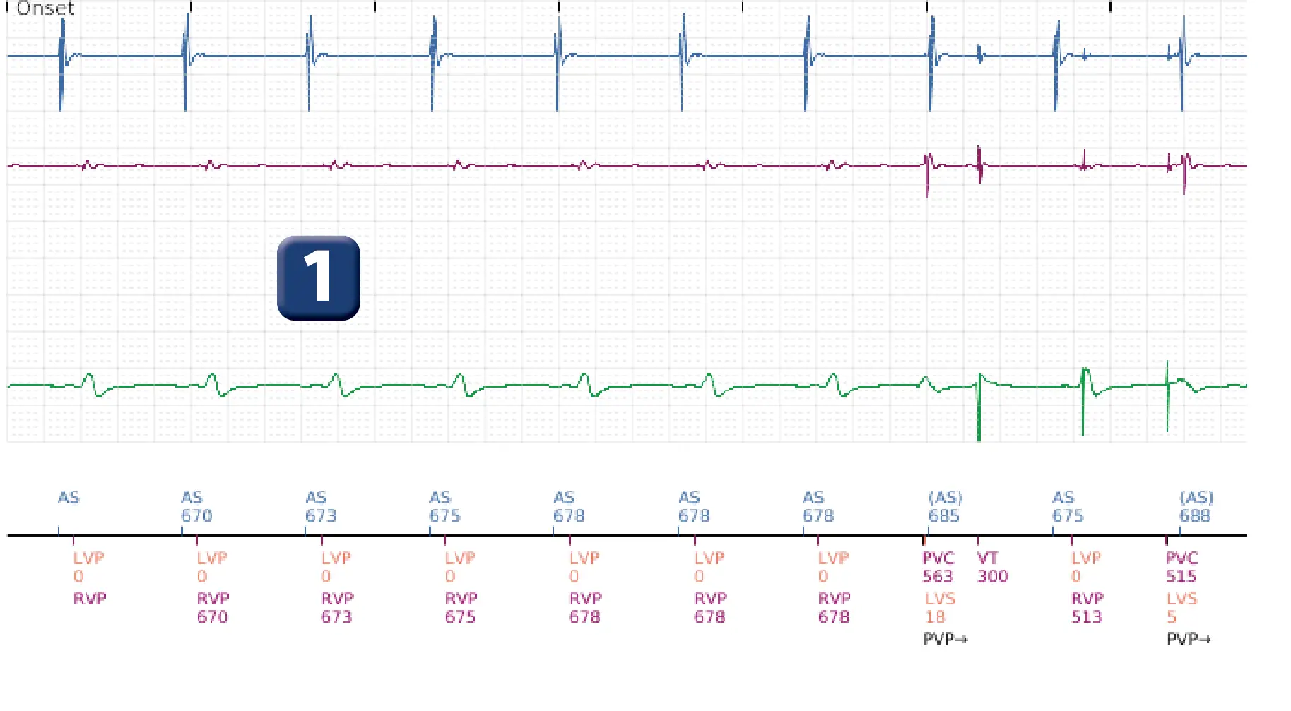 Boston Scientific ICD electrogram, segment 1 of 6 — Inappropriate therapies during a TAVI procedure