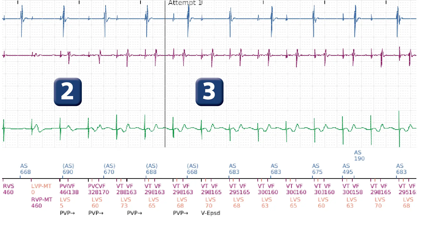 Boston Scientific ICD electrogram, segment 2 of 6 — Inappropriate therapies during a TAVI procedure