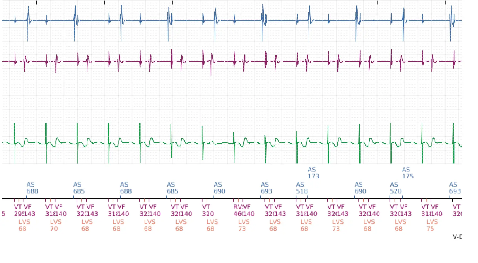 Boston Scientific ICD electrogram, segment 3 of 6 — Inappropriate therapies during a TAVI procedure