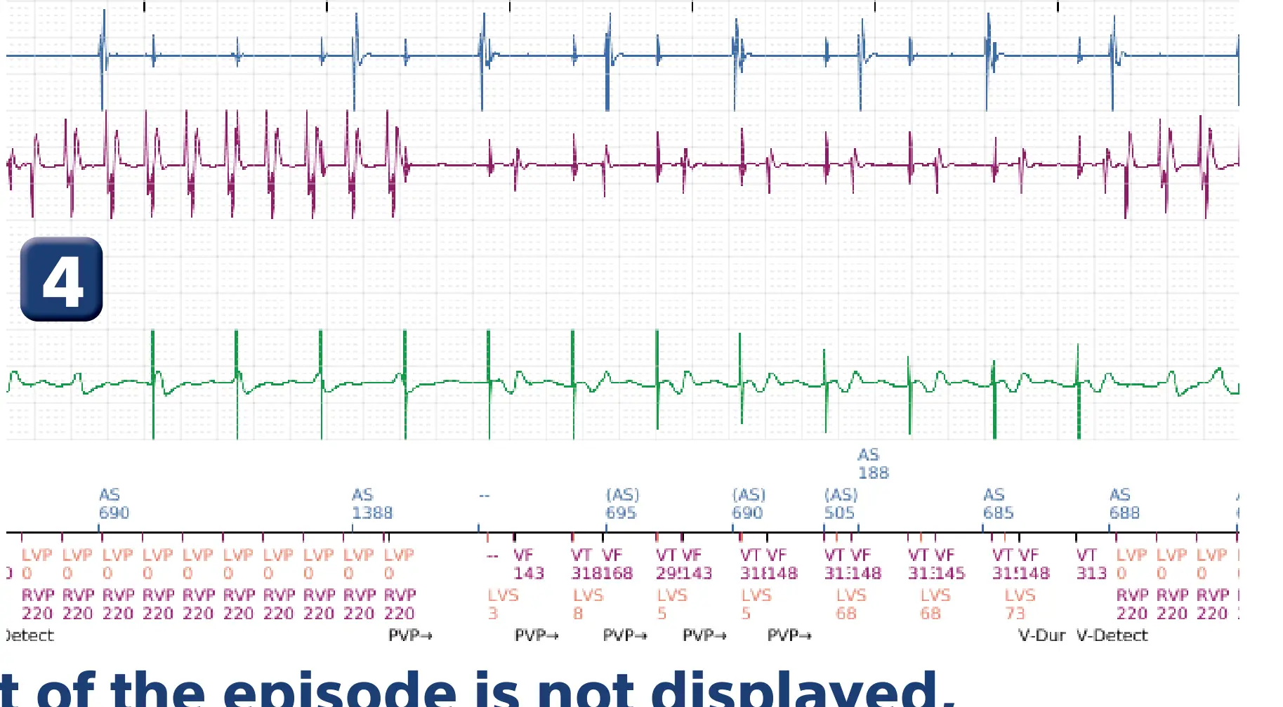 Boston Scientific ICD electrogram, segment 4 of 6 — Inappropriate therapies during a TAVI procedure