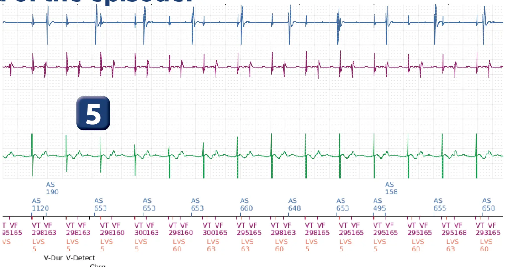 Boston Scientific ICD electrogram, segment 5 of 6 — Inappropriate therapies during a TAVI procedure