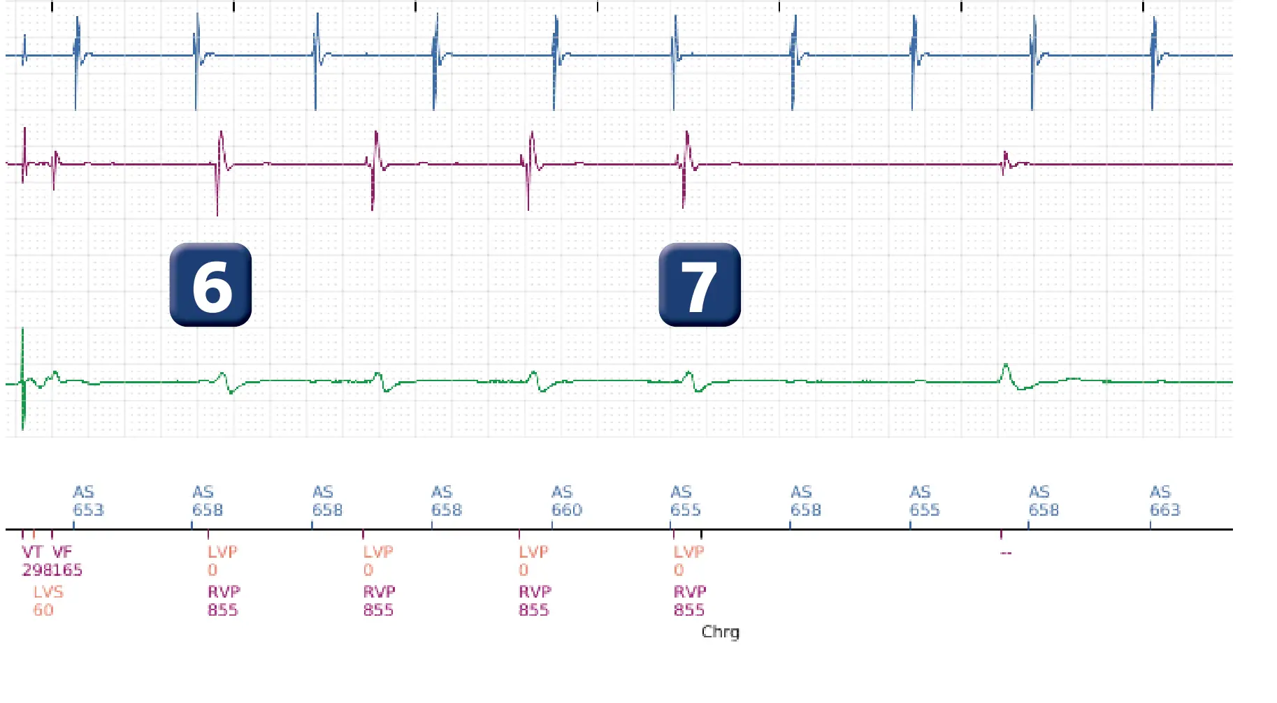 Boston Scientific ICD electrogram, segment 6 of 6 — Inappropriate therapies during a TAVI procedure