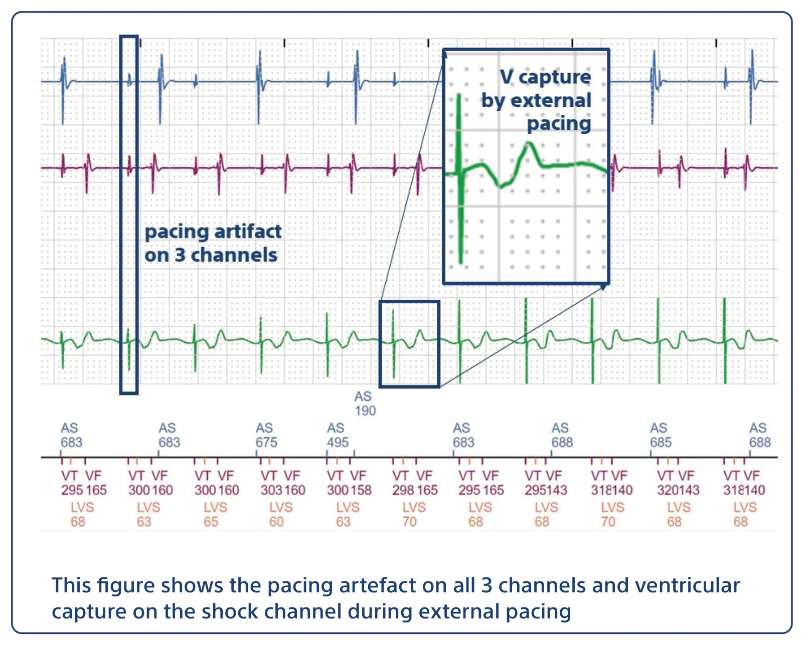 This figure shows the pacing artefact on all 3 channels and ventricular capture on the shock channel during external pacing