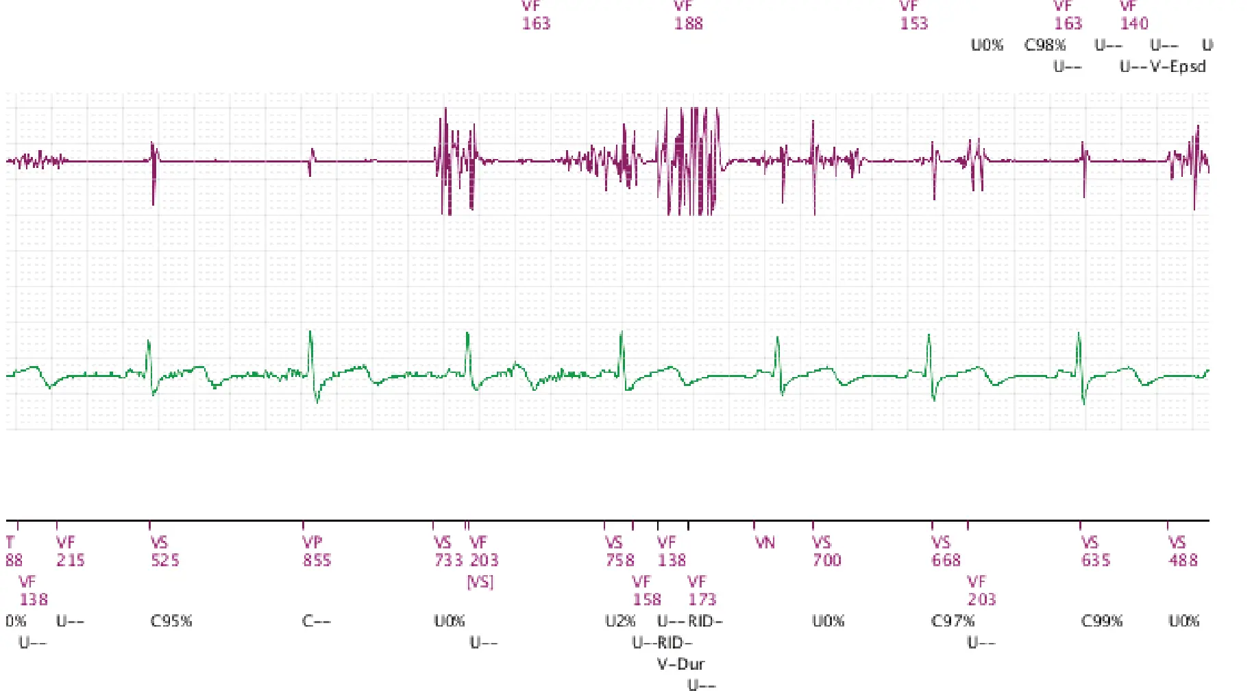 Boston Scientific ICD electrogram, segment 2 of 3 — Lead fracture and multiple capacitor charges