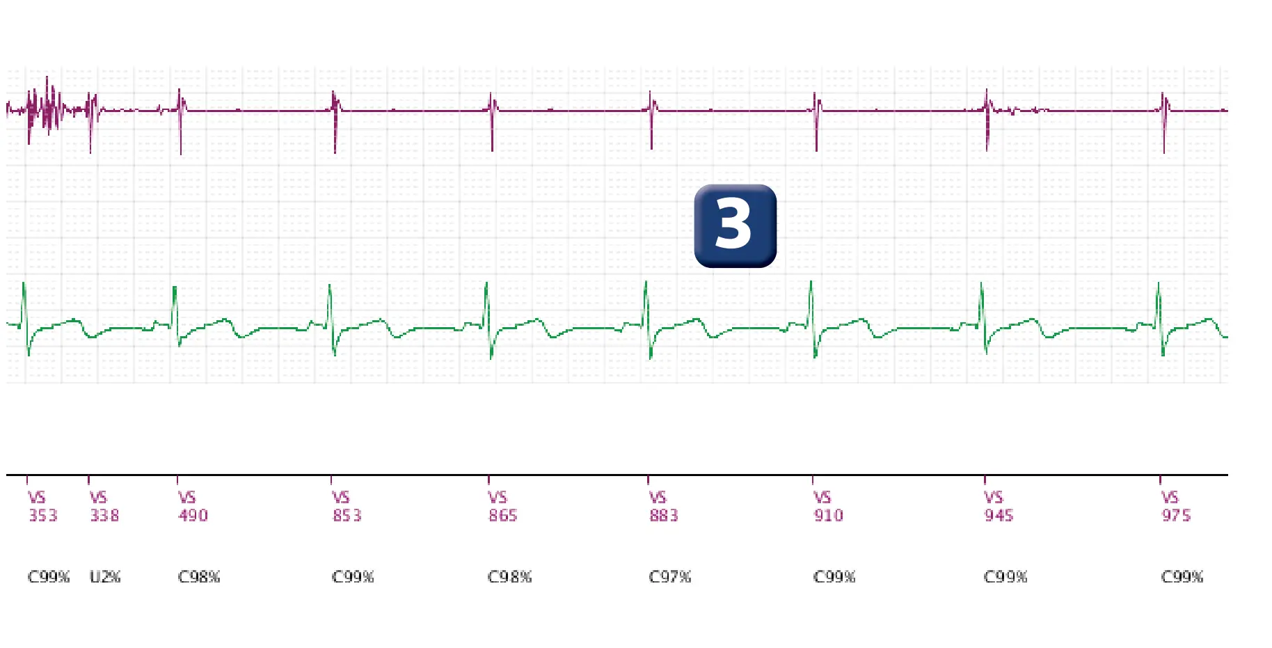 Boston Scientific ICD electrogram, segment 3 of 3 — Lead fracture and multiple capacitor charges