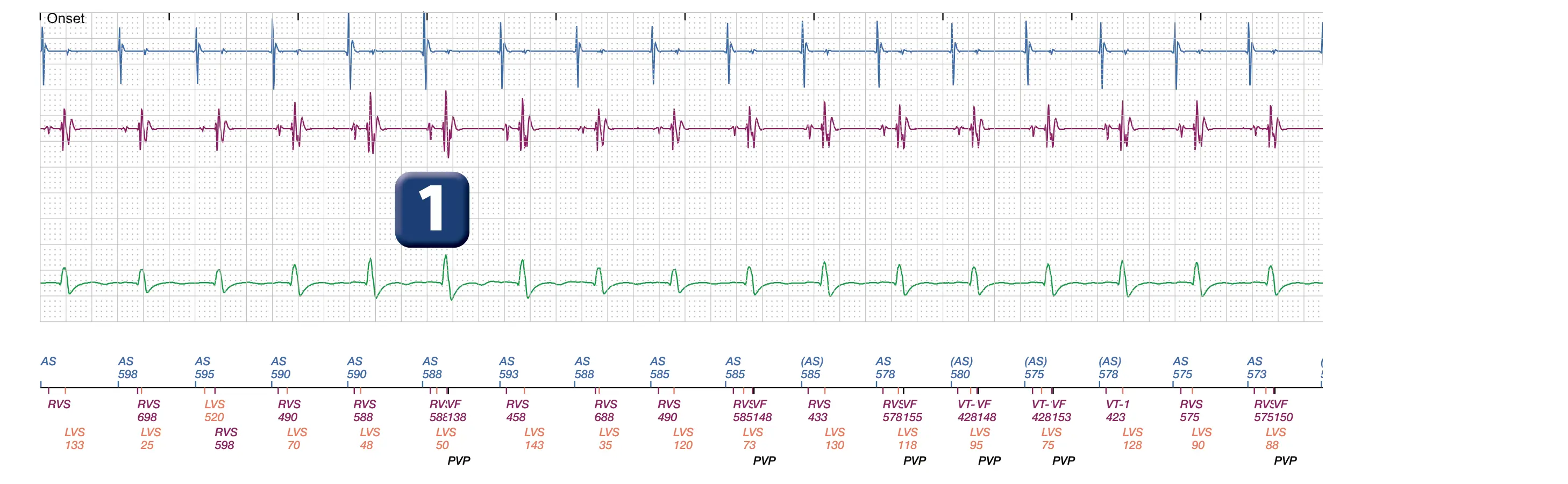 Boston Scientific ICD electrogram, segment 1 of 2 — Oversensing of the P wave by the defibrillation lead