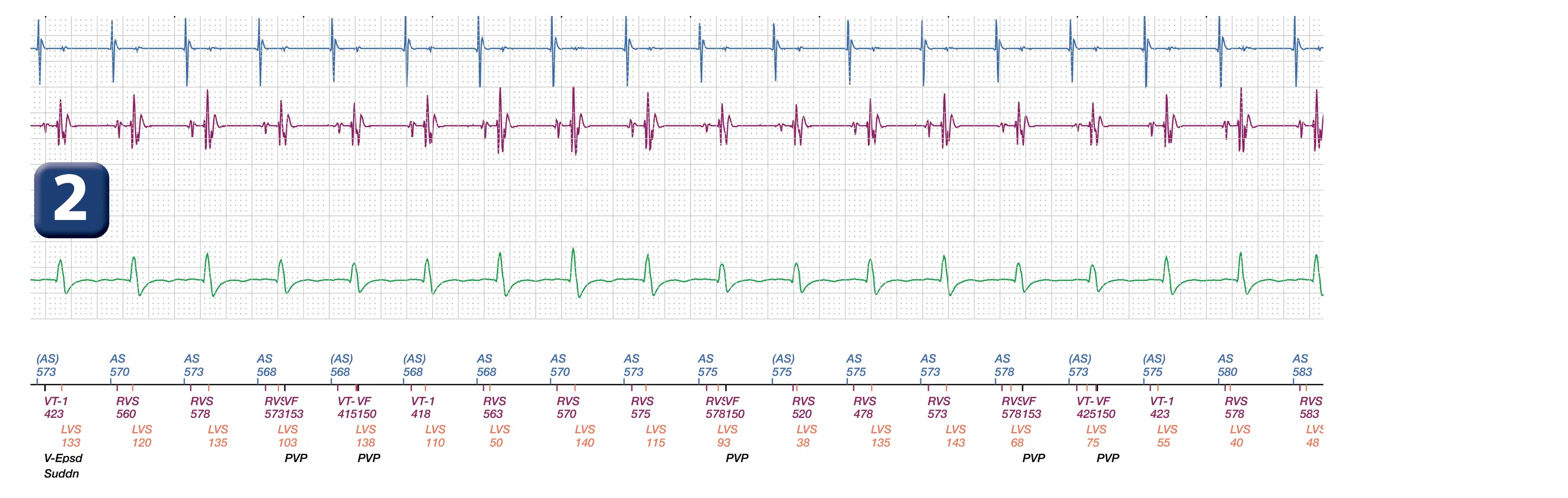 Boston Scientific ICD electrogram, segment 2 of 2 — Oversensing of the P wave by the defibrillation lead