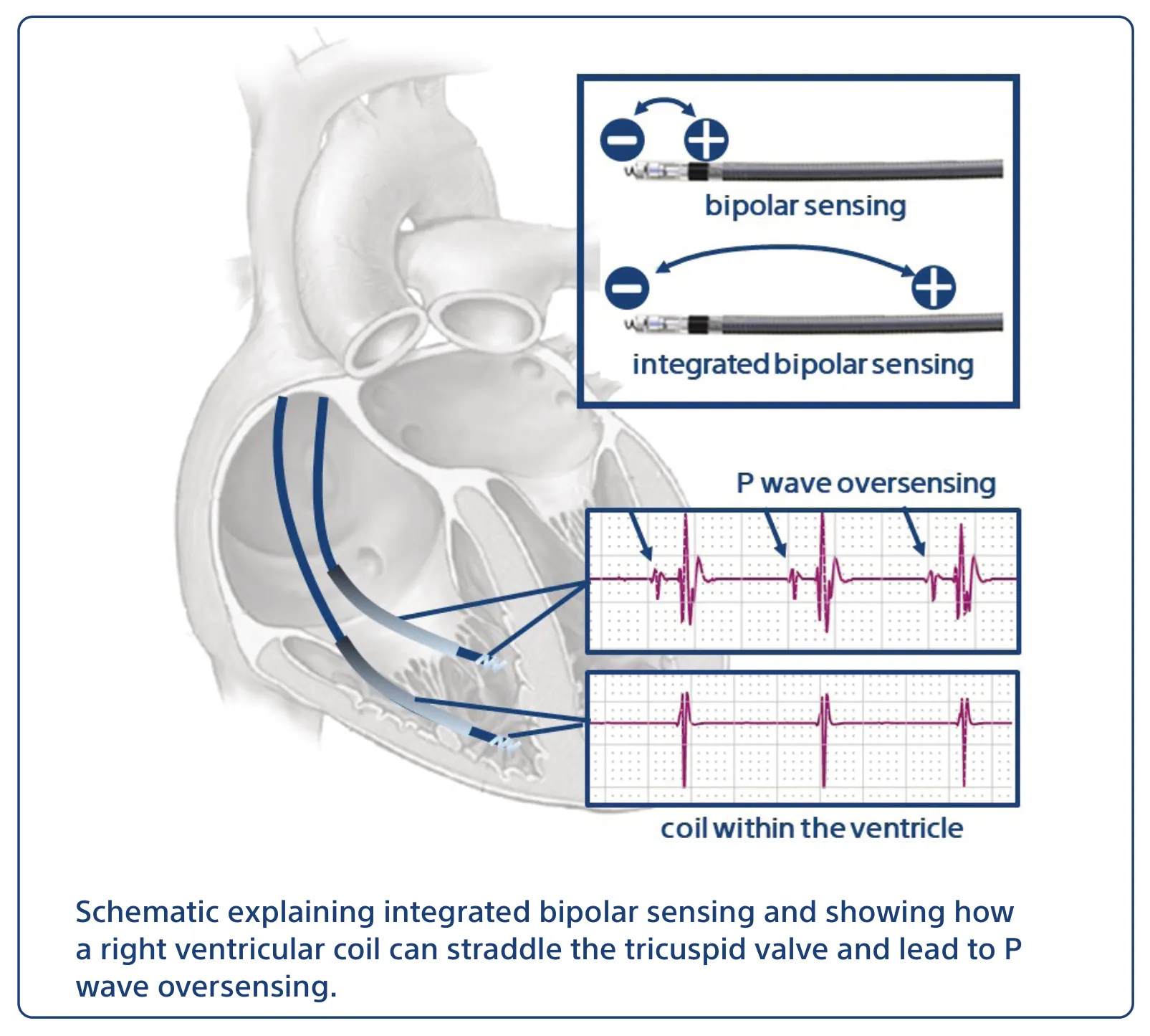 Schematic explaining integrated bipolar sensing and showing how a right ventricular coil can straddle the tricuspid valve and lead to P wave oversensing.