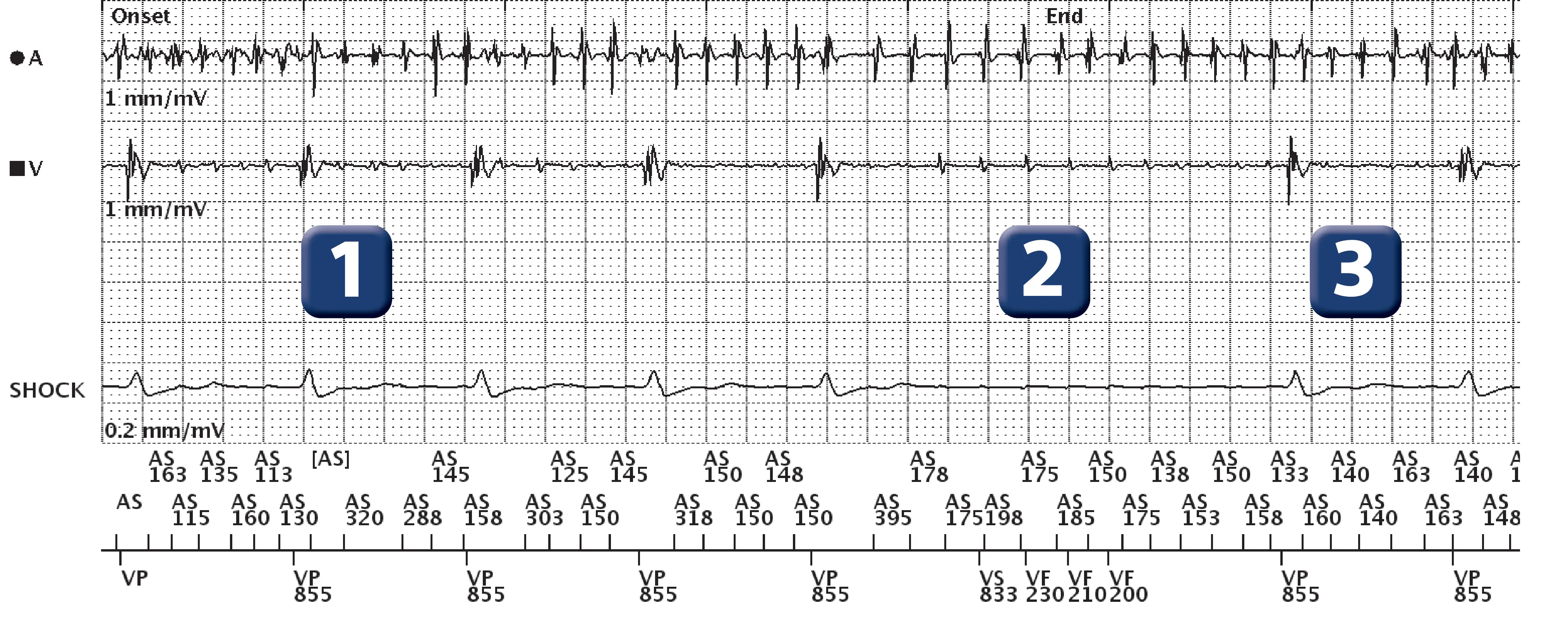 Boston Scientific ICD electrogram, segment 1 of 1 — Oversensing of atrial activity by the defibrillation lead during an episode of atrial arrhythmia
