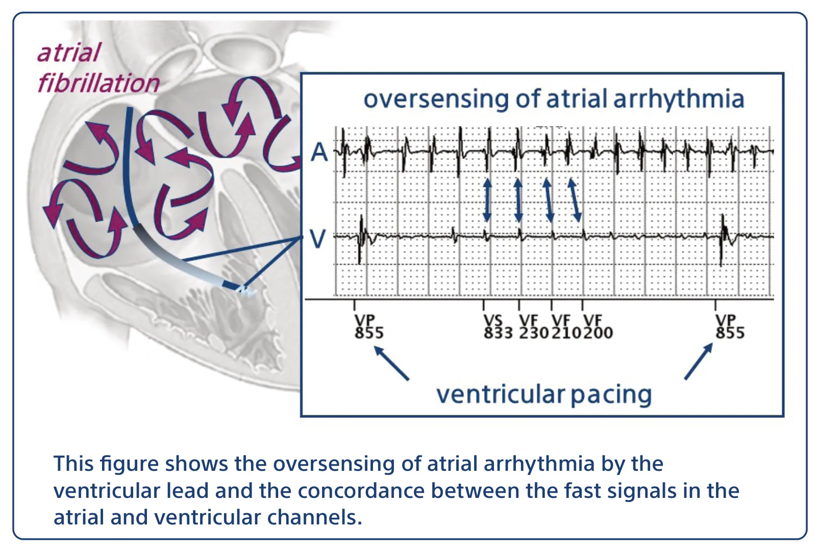 This figure shows the oversensing of atrial arrhythmia by the ventricular lead and the concordance between the fast signals in the atrial and ventricular channels.