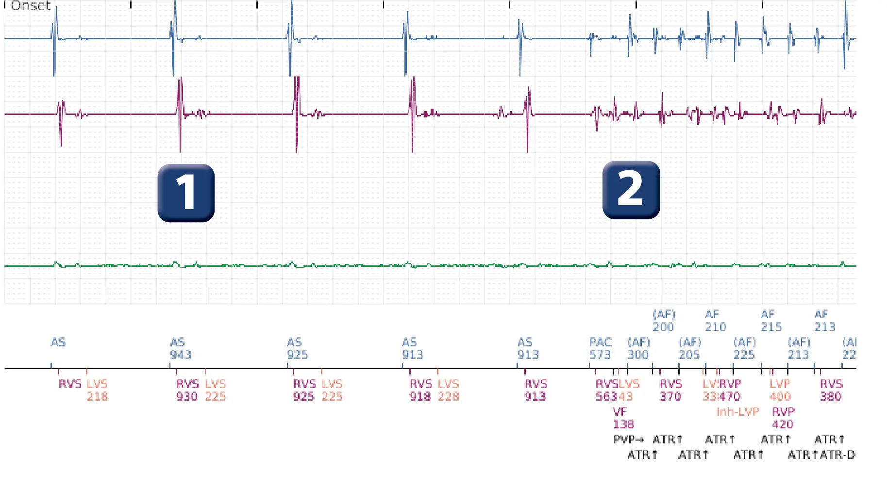 Boston Scientific ICD electrogram, segment 1 of 8 — Early displacement of a right ventricular lead into the atrium