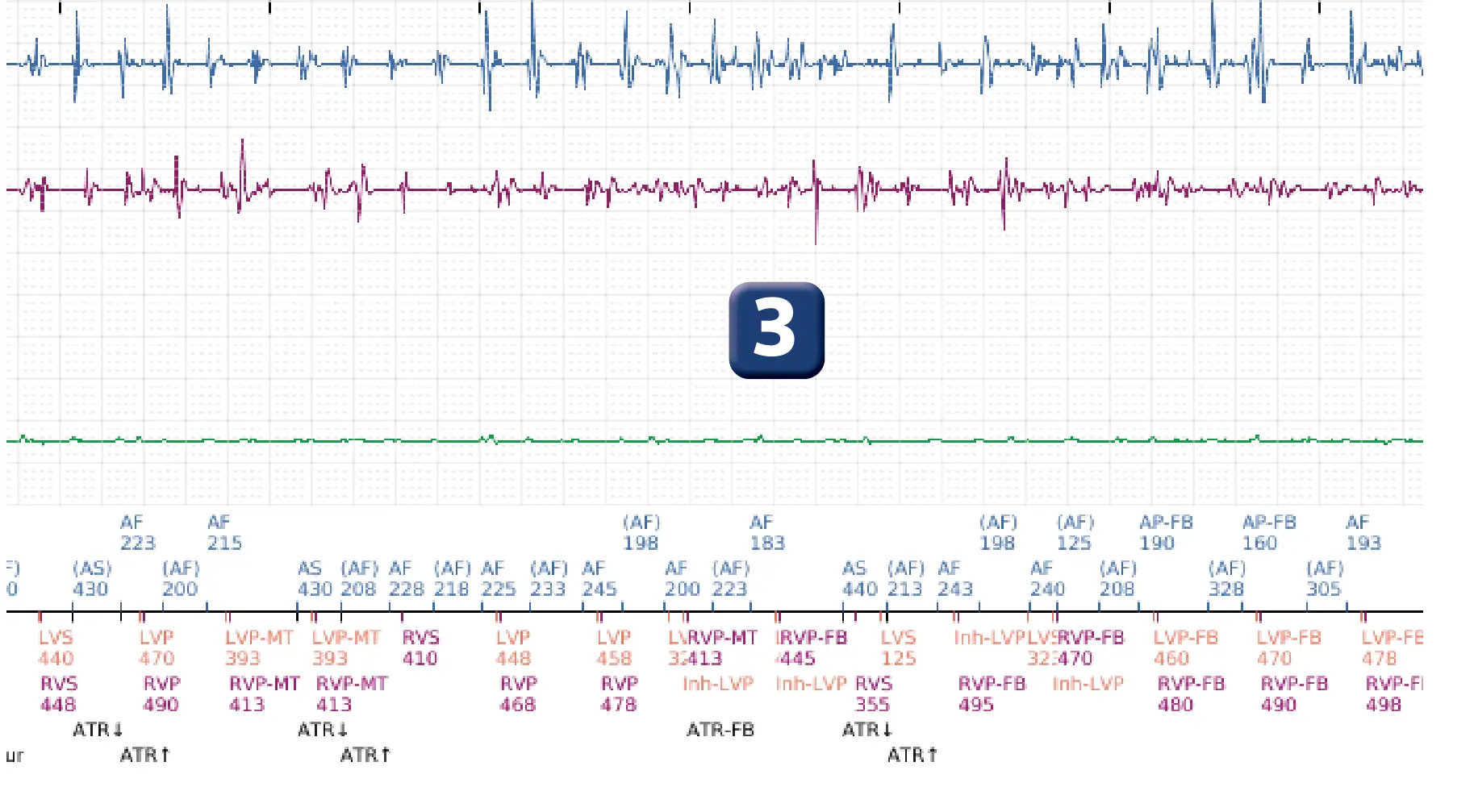 Boston Scientific ICD electrogram, segment 2 of 8 — Early displacement of a right ventricular lead into the atrium