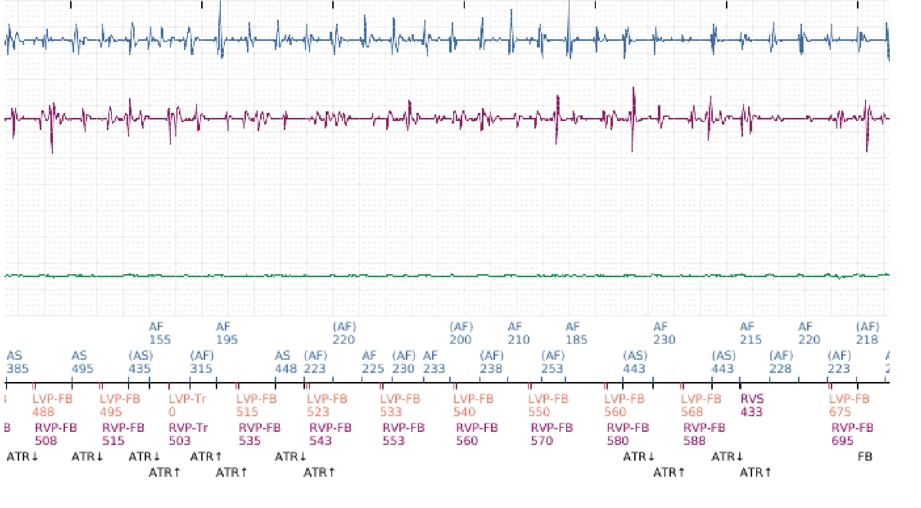 Boston Scientific ICD electrogram, segment 3 of 8 — Early displacement of a right ventricular lead into the atrium