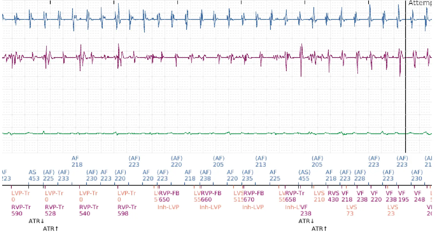 Boston Scientific ICD electrogram, segment 4 of 8 — Early displacement of a right ventricular lead into the atrium