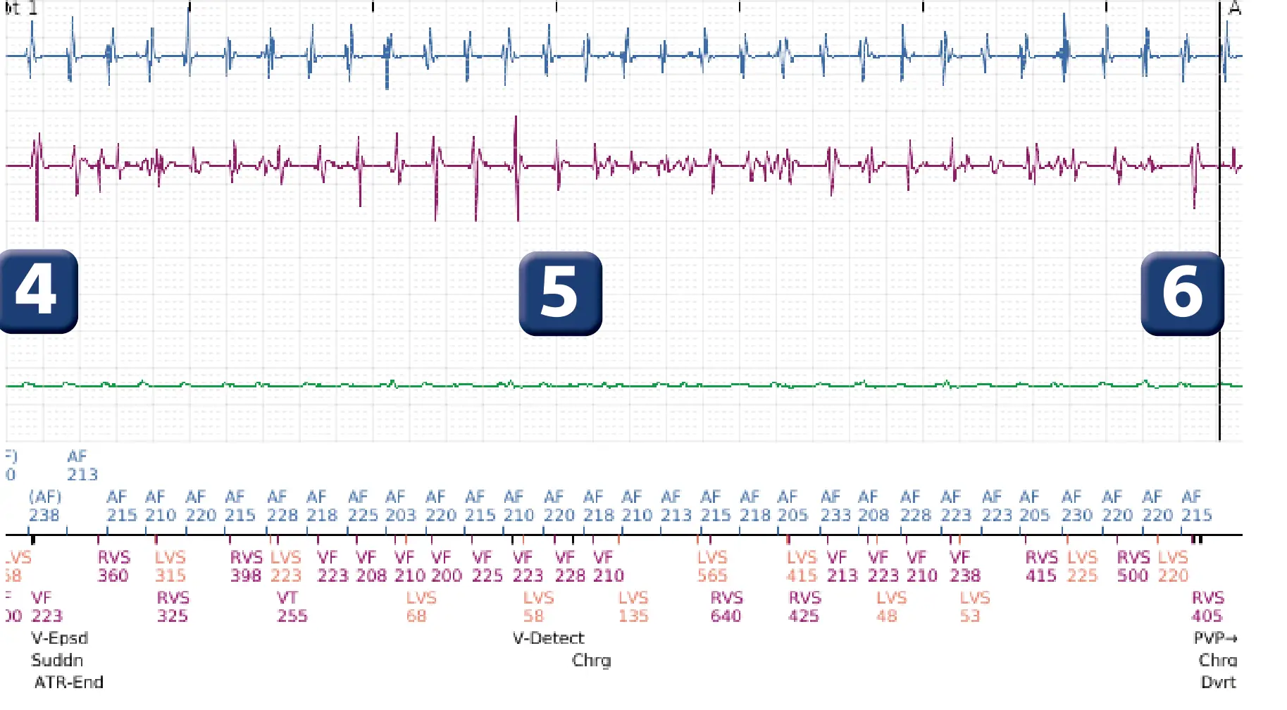 Boston Scientific ICD electrogram, segment 5 of 8 — Early displacement of a right ventricular lead into the atrium