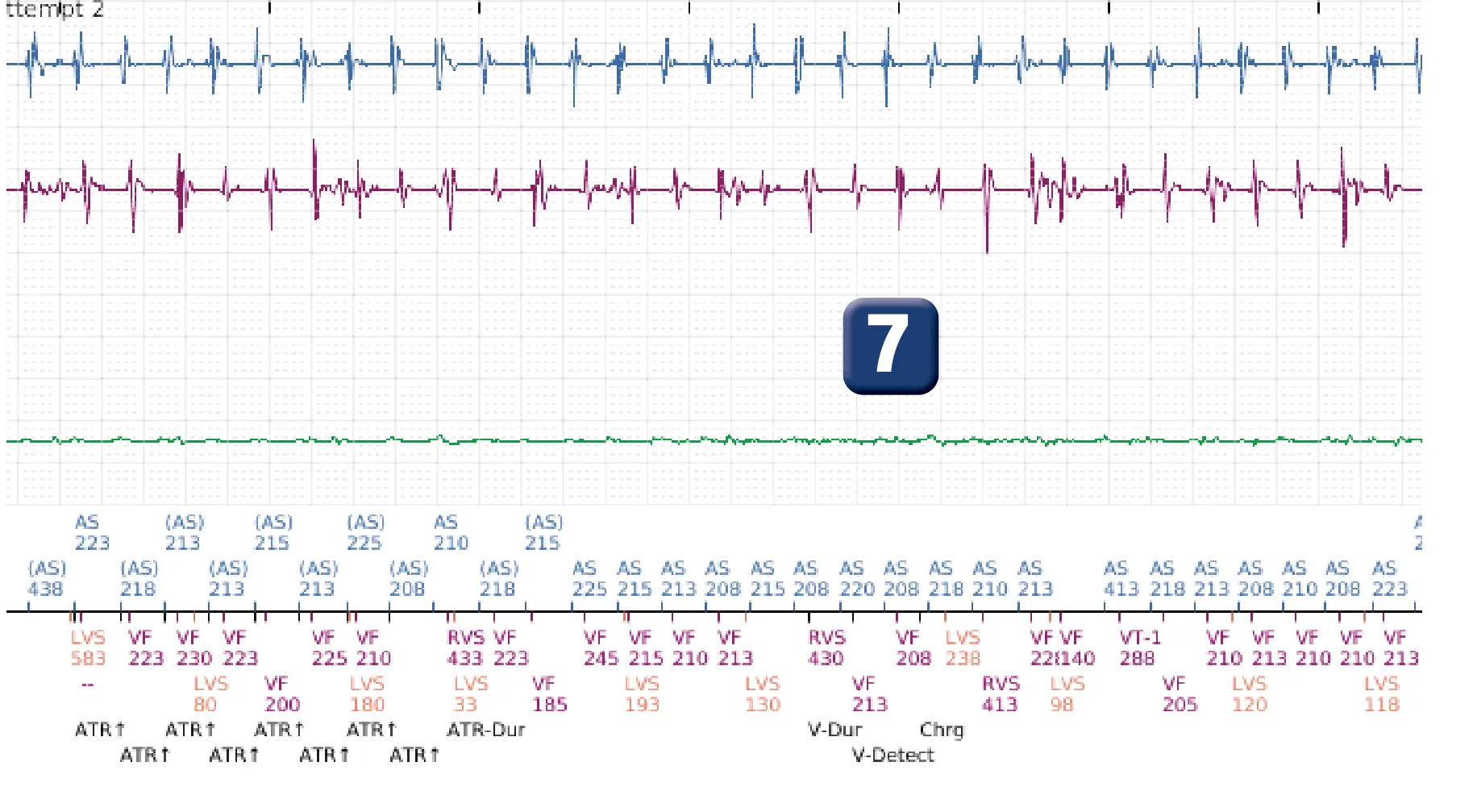 Boston Scientific ICD electrogram, segment 6 of 8 — Early displacement of a right ventricular lead into the atrium
