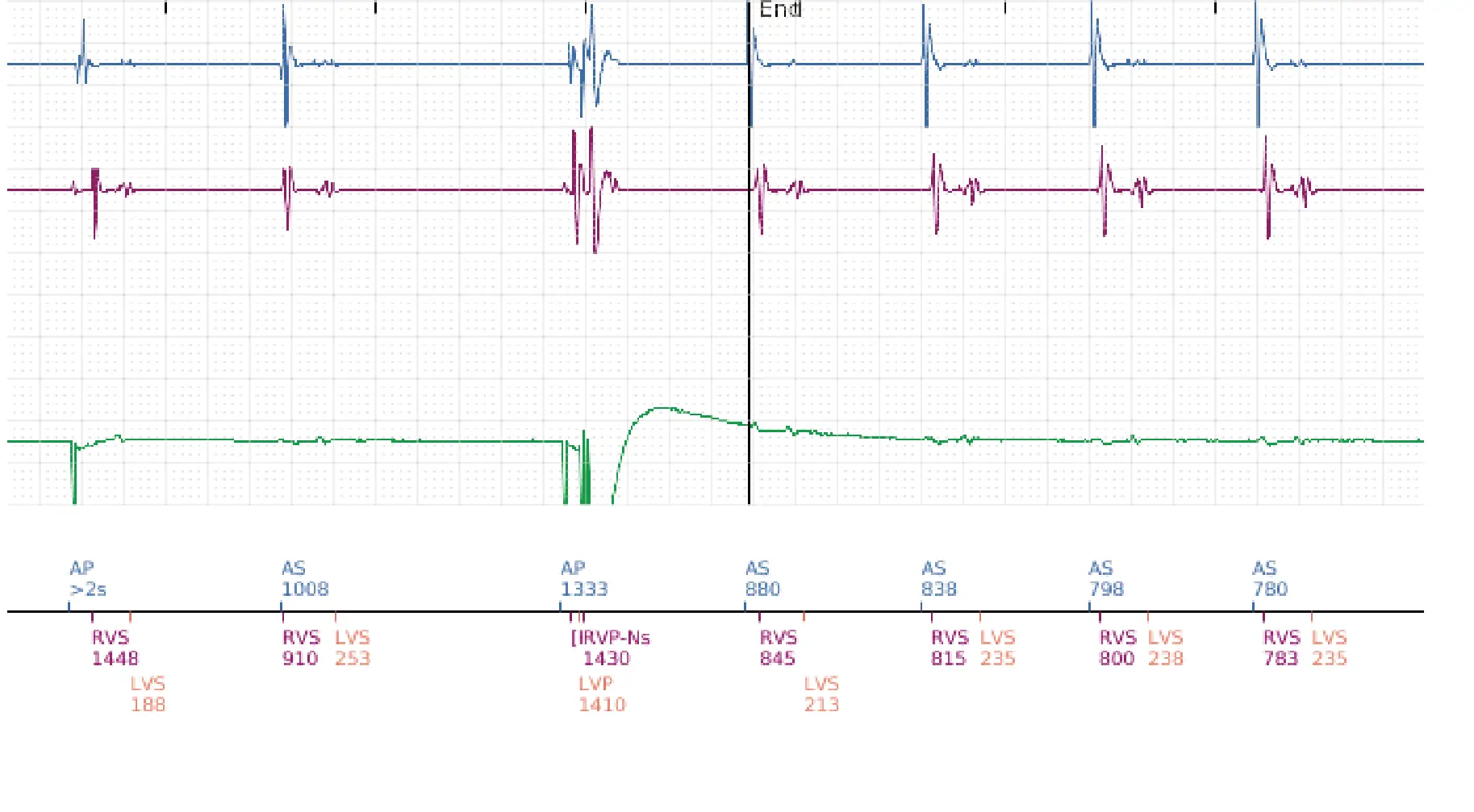 Boston Scientific ICD electrogram, segment 8 of 8 — Early displacement of a right ventricular lead into the atrium