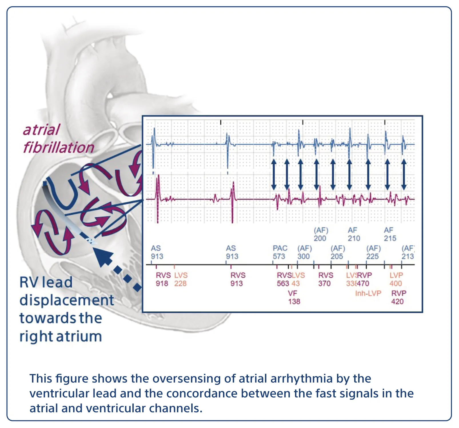 This figure shows the oversensing of atrial arrhythmia by the ventricular lead and the concordance between the fast signals in the atrial and ventricular channels.