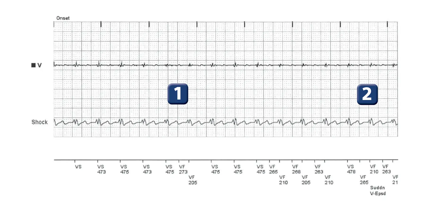 Boston Scientific ICD electrogram, segment 1 of 6 — T wave oversensing