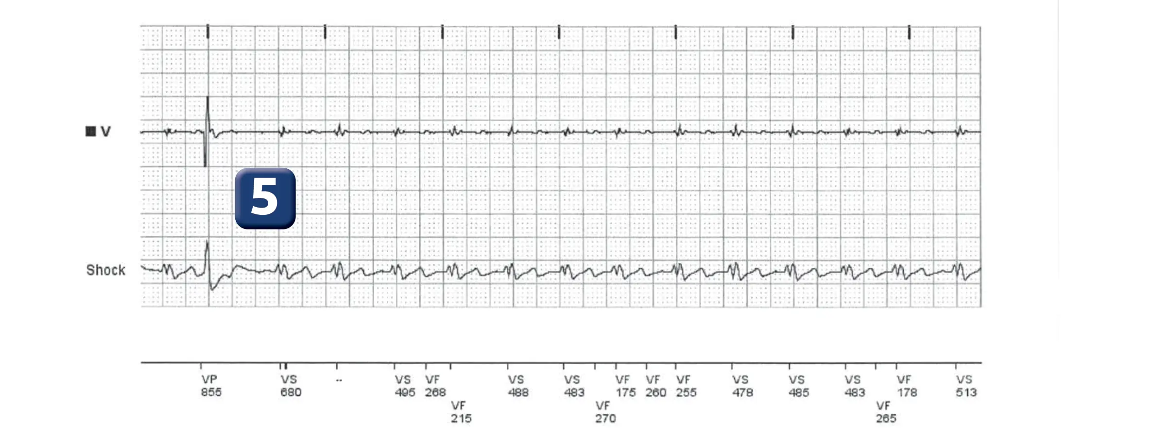 Boston Scientific ICD electrogram, segment 3 of 6 — T wave oversensing