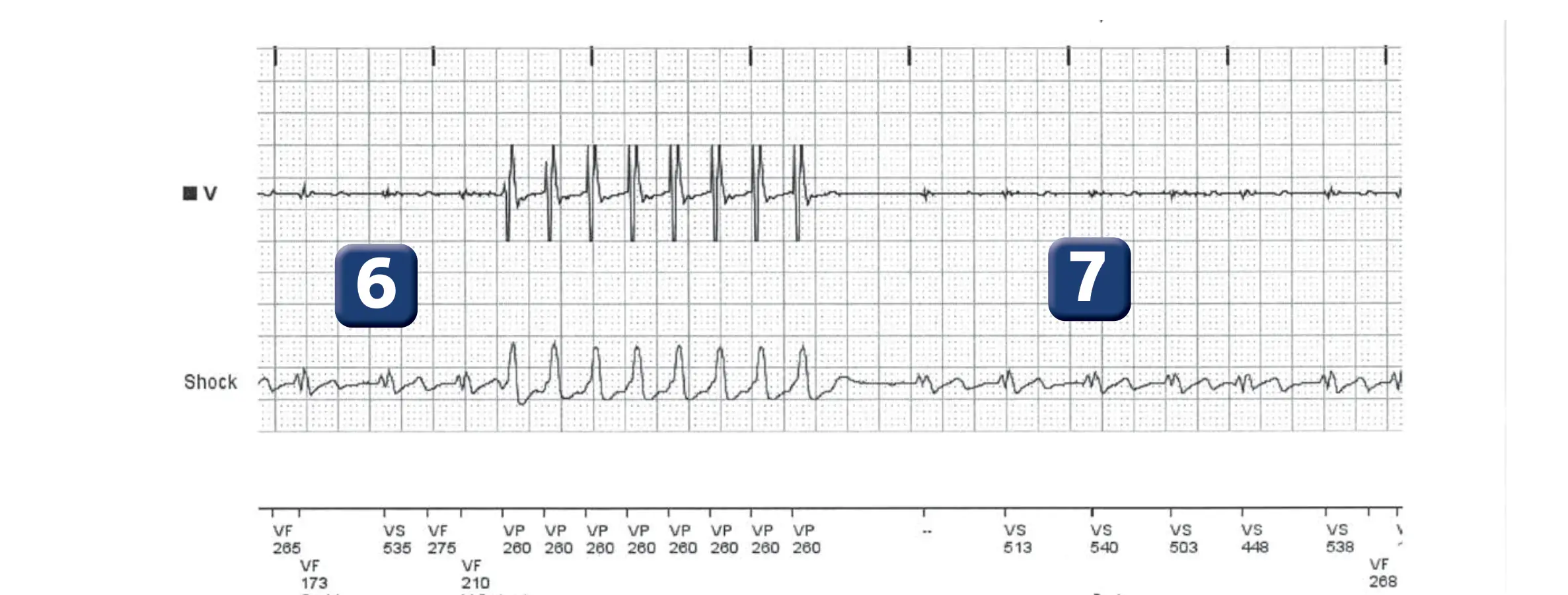 Boston Scientific ICD electrogram, segment 5 of 6 — T wave oversensing