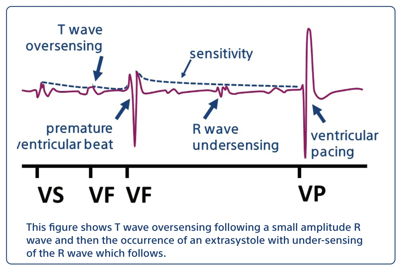 This figure shows T wave oversensing following a small amplitude R wave and then the occurrence of an extrasystole with under-sensing of the R wave which follows.