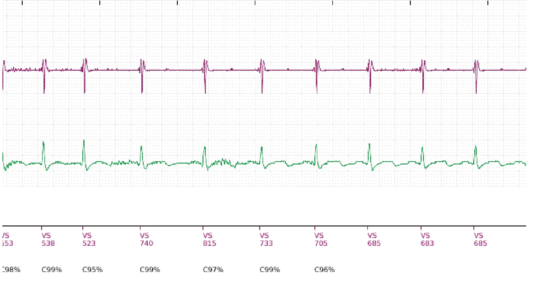 Boston Scientific ICD electrogram, segment 2 of 2 — Oversensing of diaphragmatic myopotentials