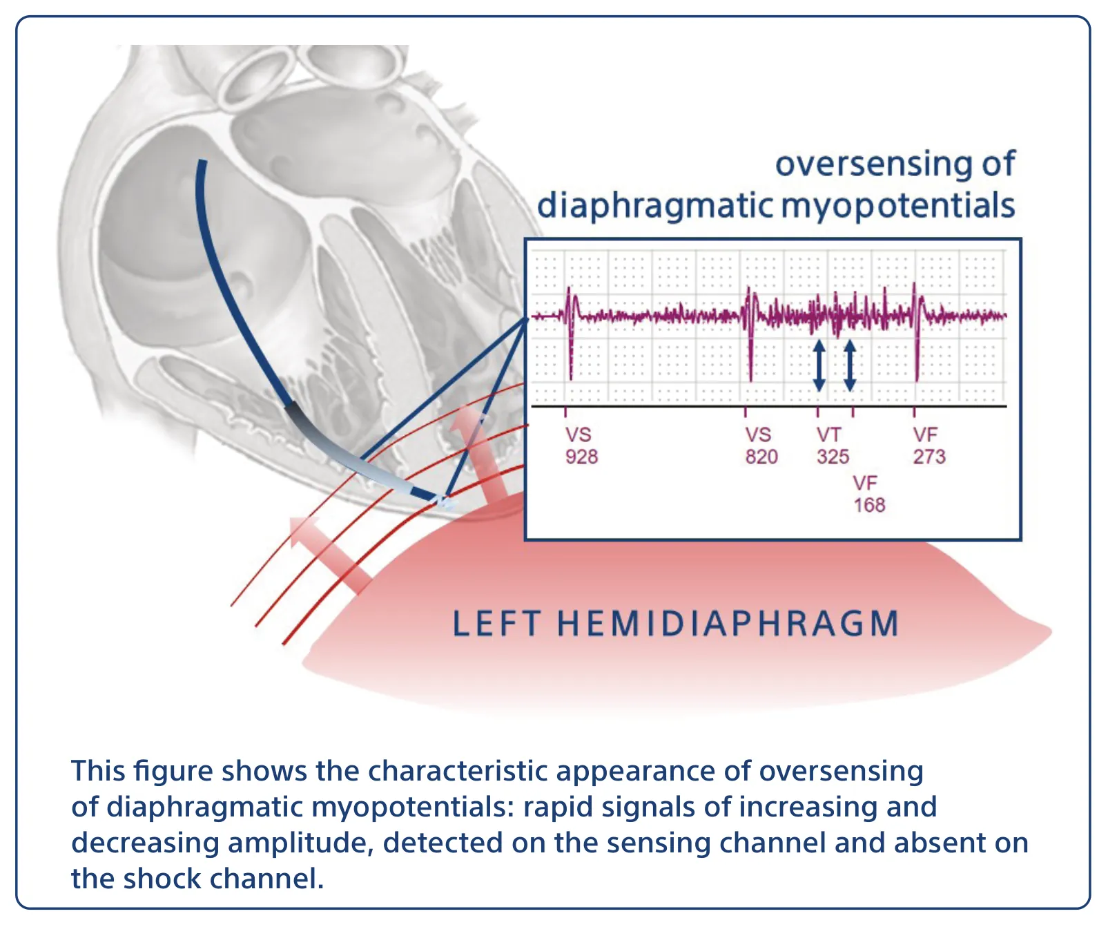 This figure shows the characteristic appearance of oversensing of diaphragmatic myopotentials: rapid signals of increasing and decreasing amplitude, detected on the sensing channel and absent on the shock channel.