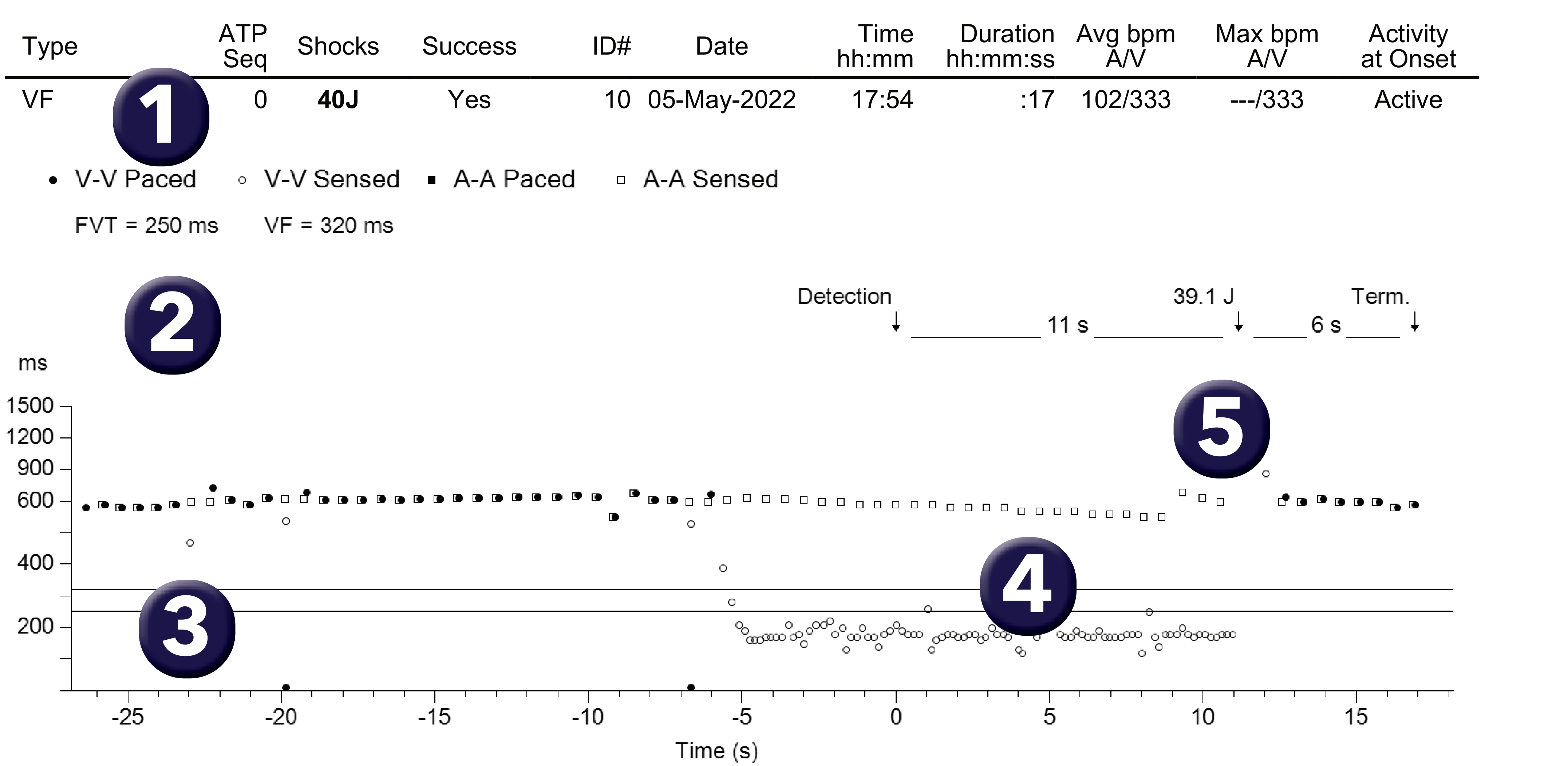 Medtronic ICD electrogram, segment 1 of 1 — Analysis of a VF trace recorded by the device