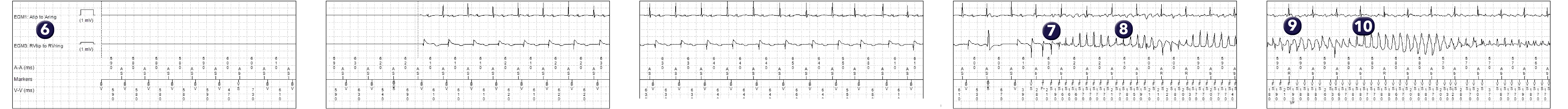 Medtronic ICD electrogram, segment 1 of 2 — Analysis of a VF trace recorded by the device