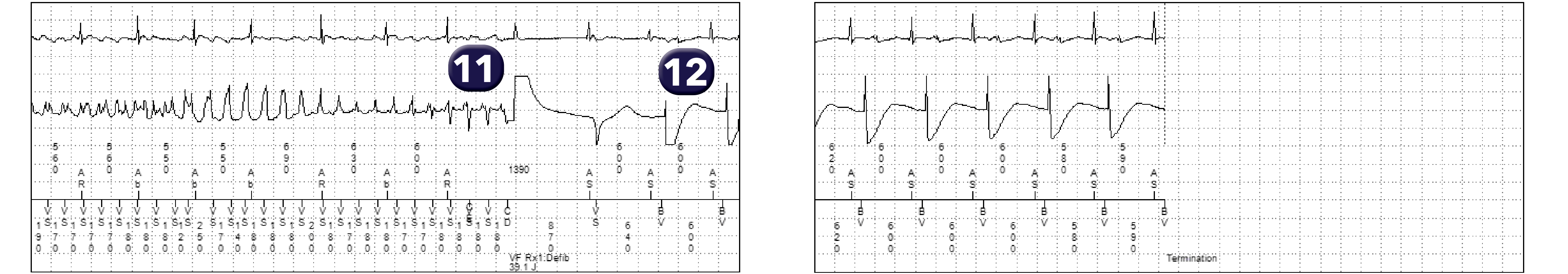 Medtronic ICD electrogram, segment 2 of 2 — Analysis of a VF trace recorded by the device
