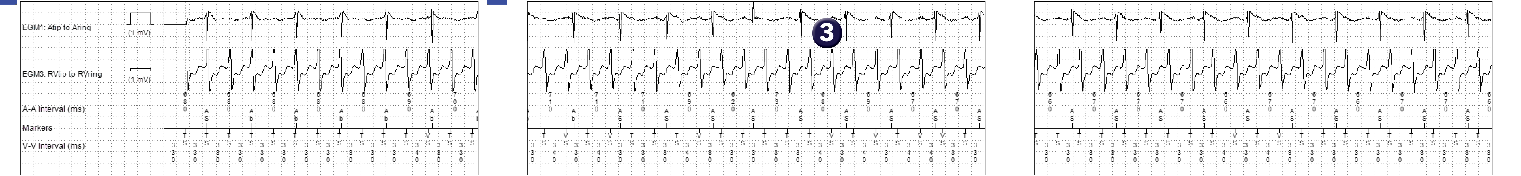 Medtronic ICD electrogram, segment 1 of 1 — Zone limits and the VT counter