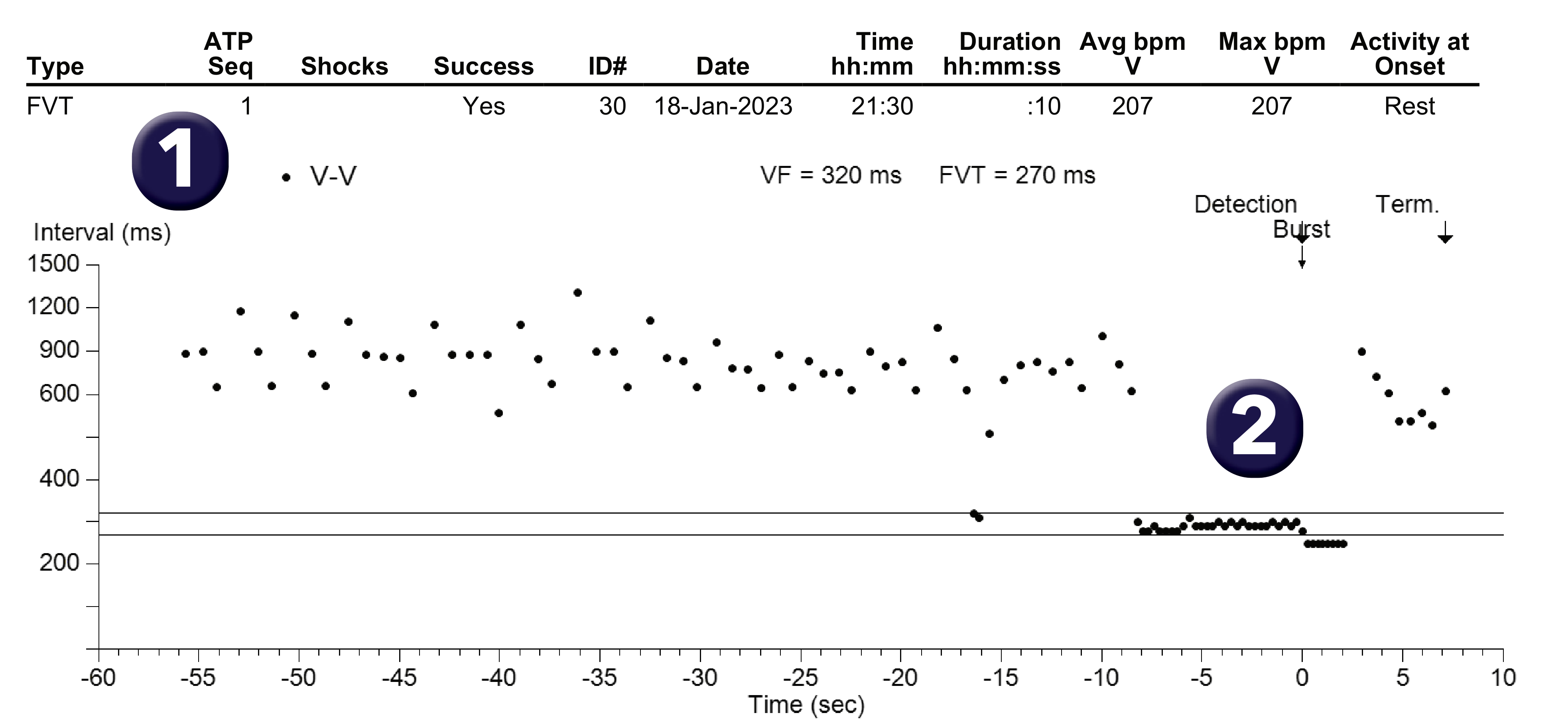 Medtronic ICD electrogram, segment 1 of 1 — Specific features of the fast VT counter